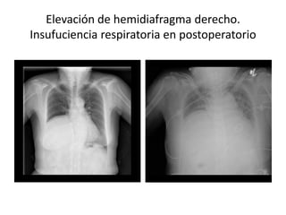 Elevación de hemidiafragma derecho.
Insufuciencia respiratoria en postoperatorio
 