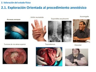 2.1. Exploración Orientada al procedimiento anestésico
2. Valoración del estado físico
Accesos venosos
Artritis reumatoide
Espondilitis anquilosante
Acromegalia
Tumores de vía aérea superior Traumatismos Obesidad
 