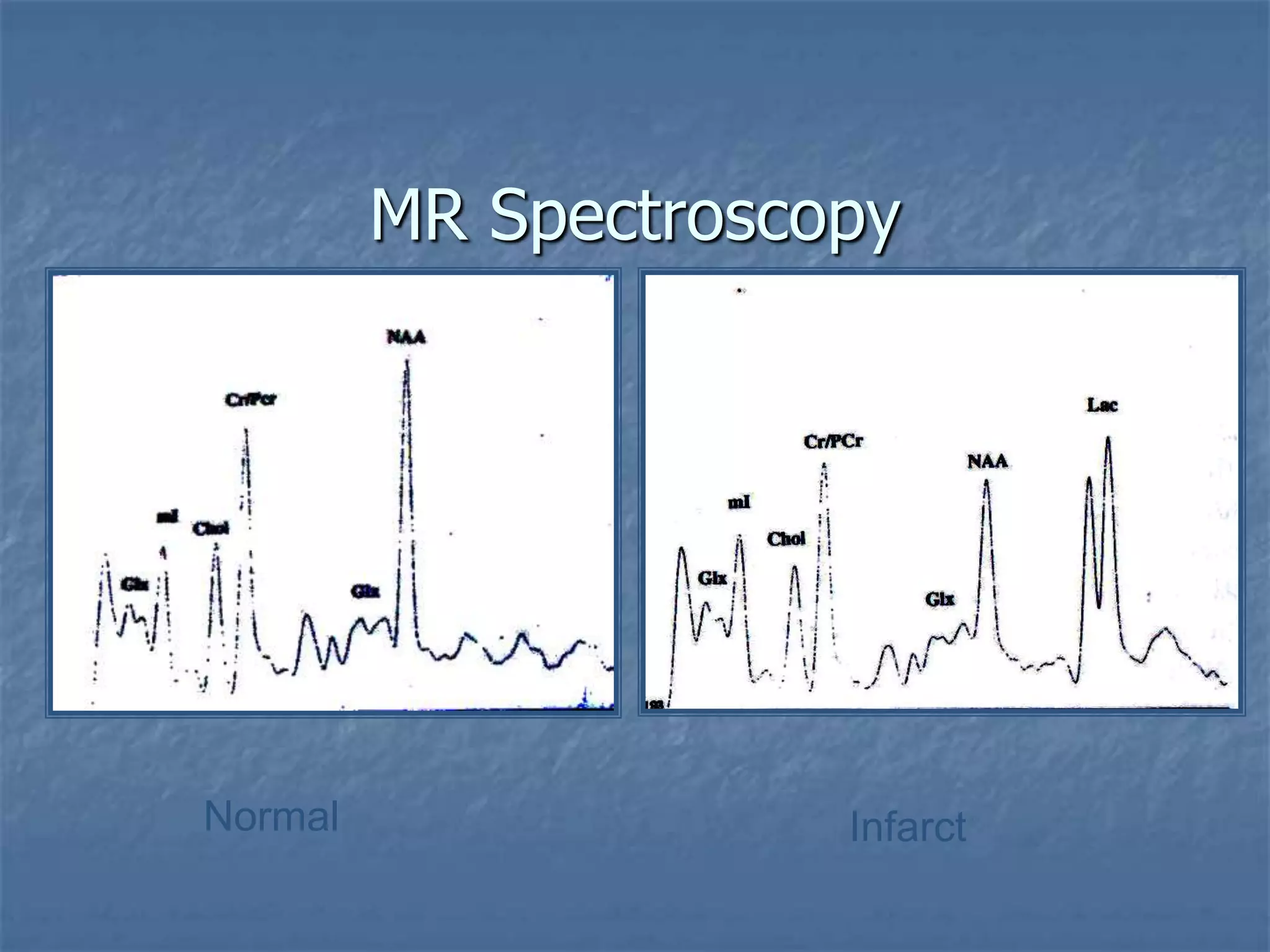 MR Spectroscopy
Normal Infarct
 