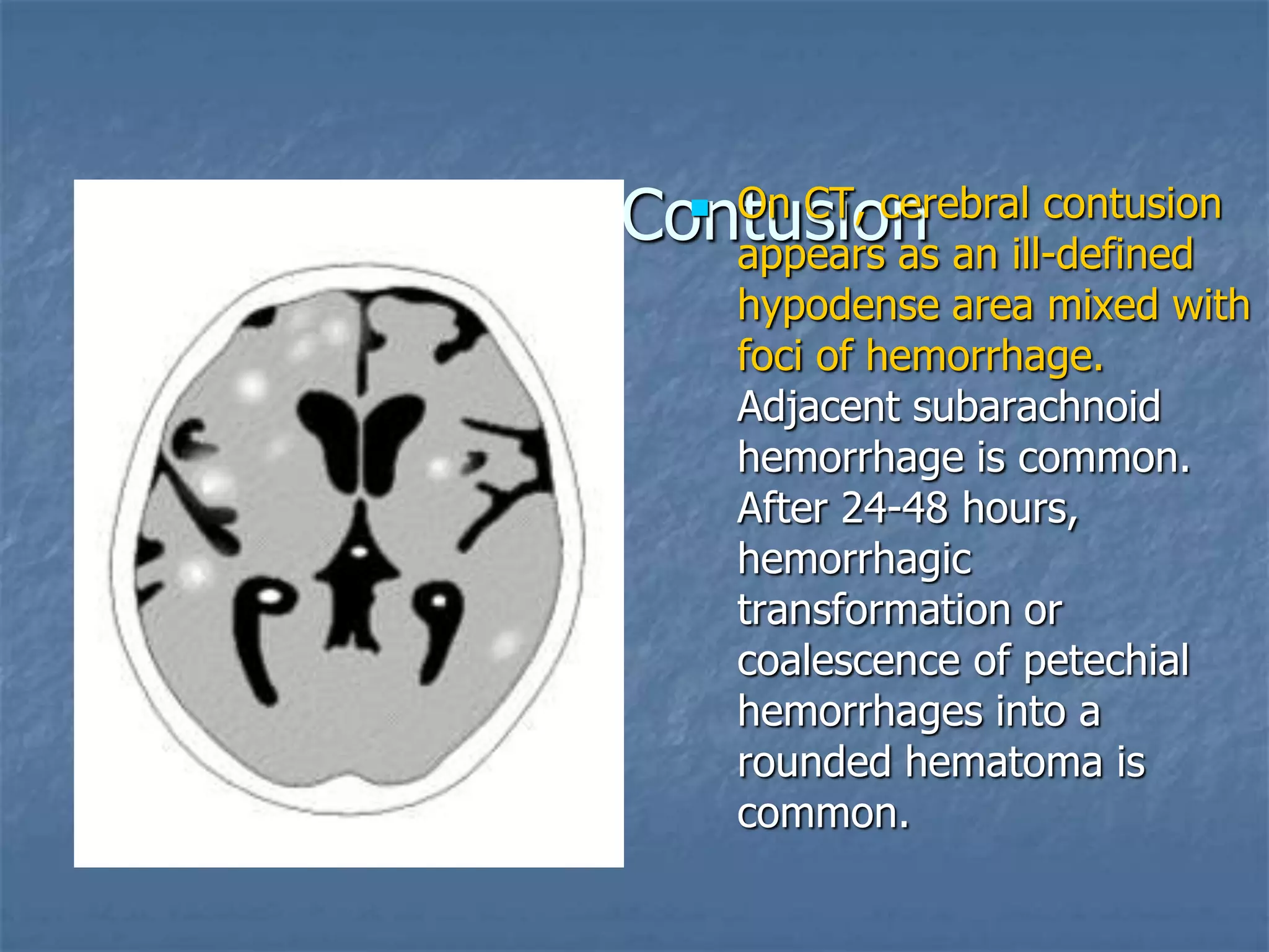 Cerebral Contusion On CT, cerebral contusion
appears as an ill-defined
hypodense area mixed with
foci of hemorrhage.
Adjacent subarachnoid
hemorrhage is common.
After 24-48 hours,
hemorrhagic
transformation or
coalescence of petechial
hemorrhages into a
rounded hematoma is
common.
 