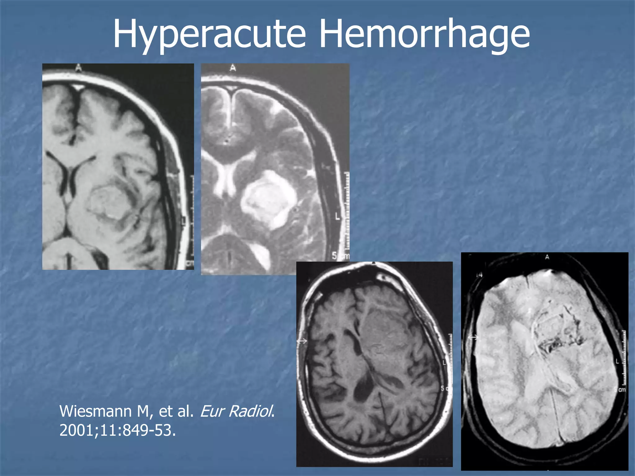 Hyperacute Hemorrhage
Wiesmann M, et al. Eur Radiol.
2001;11:849-53.
 