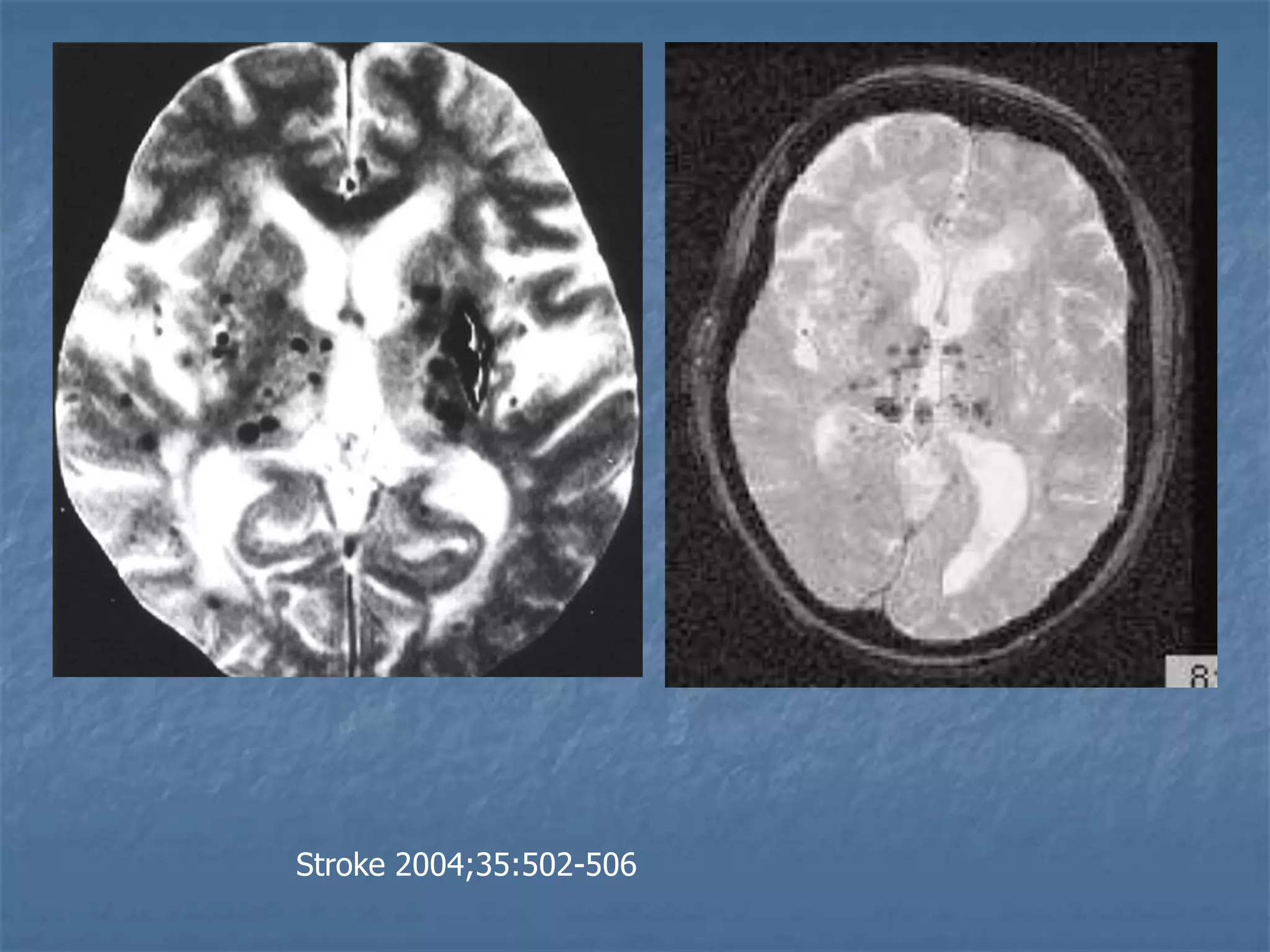 Stroke 2004;35:502-506
 