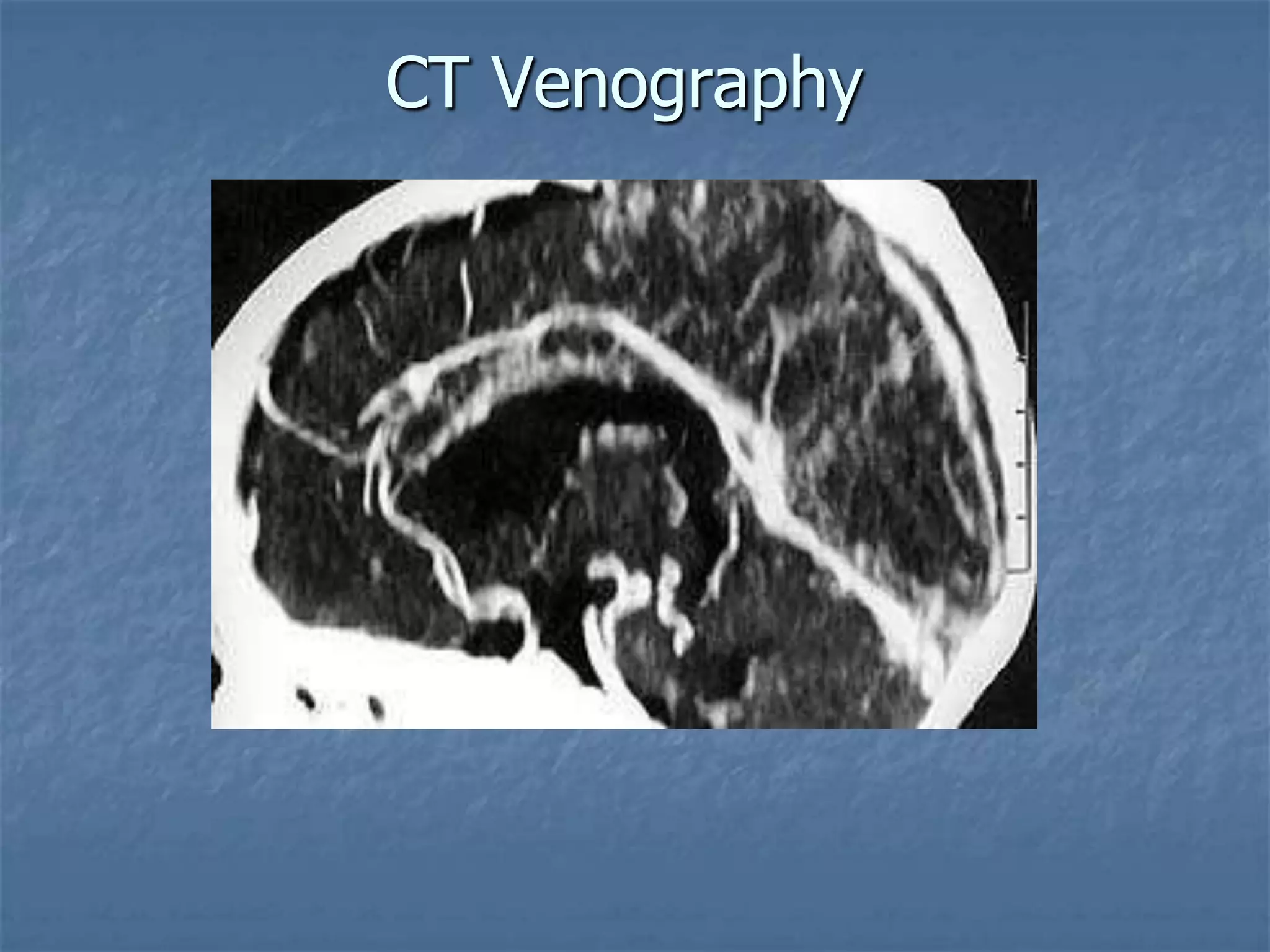 CT Venography
 