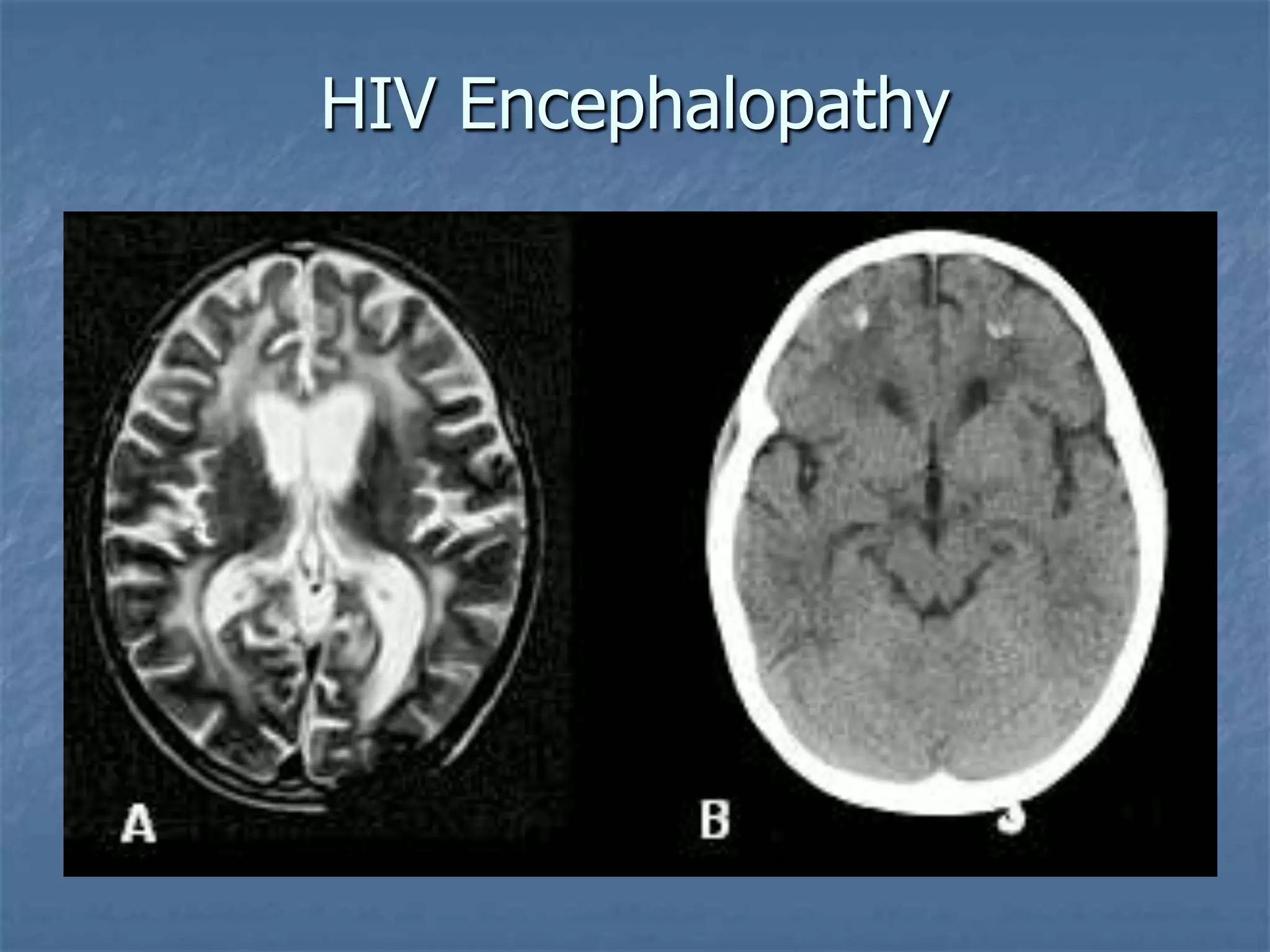 HIV Encephalopathy
 
