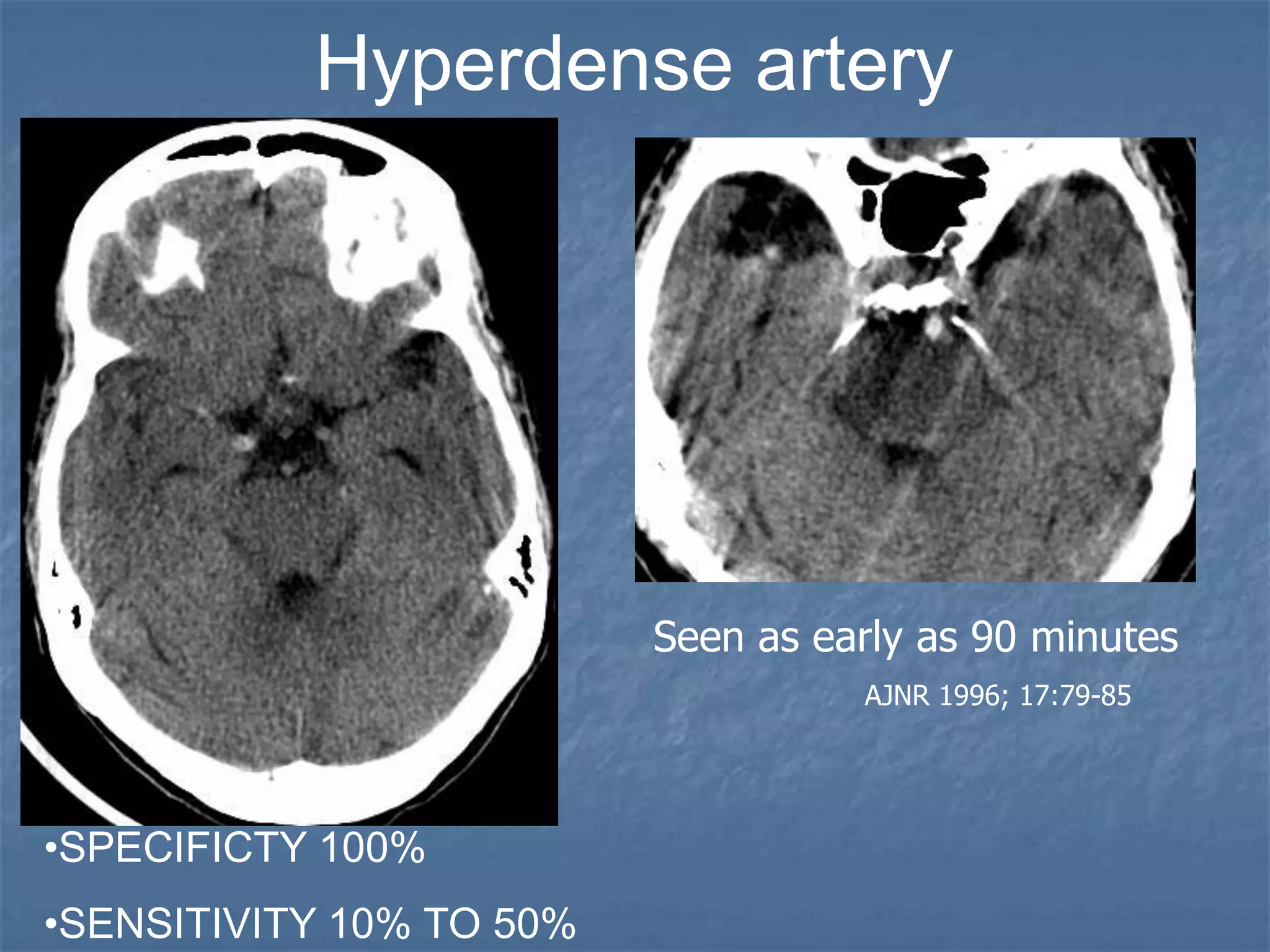 Hyperdense artery
•SPECIFICTY 100%
•SENSITIVITY 10% TO 50%
Seen as early as 90 minutes
AJNR 1996; 17:79-85
 