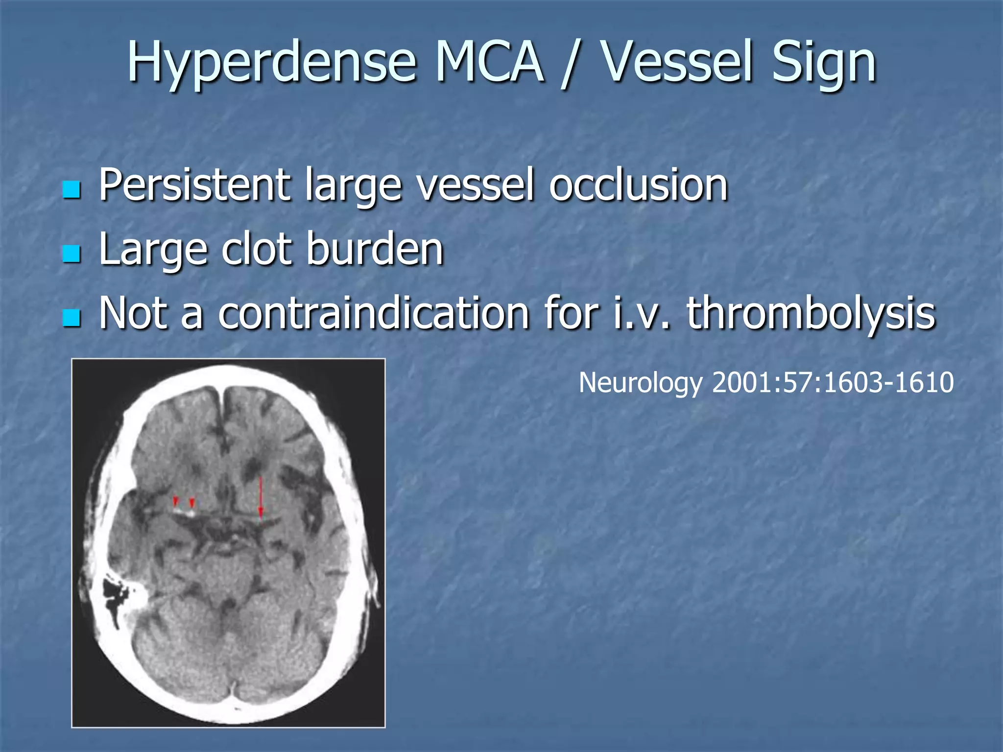 Hyperdense MCA / Vessel Sign
 Persistent large vessel occlusion
 Large clot burden
 Not a contraindication for i.v. thrombolysis
Neurology 2001:57:1603-1610
 