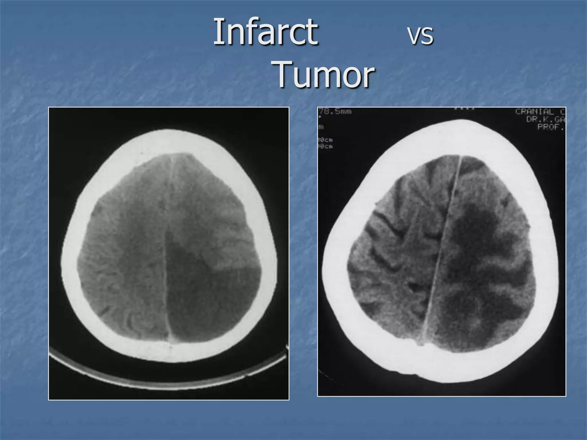 Infarct VS
Tumor
 