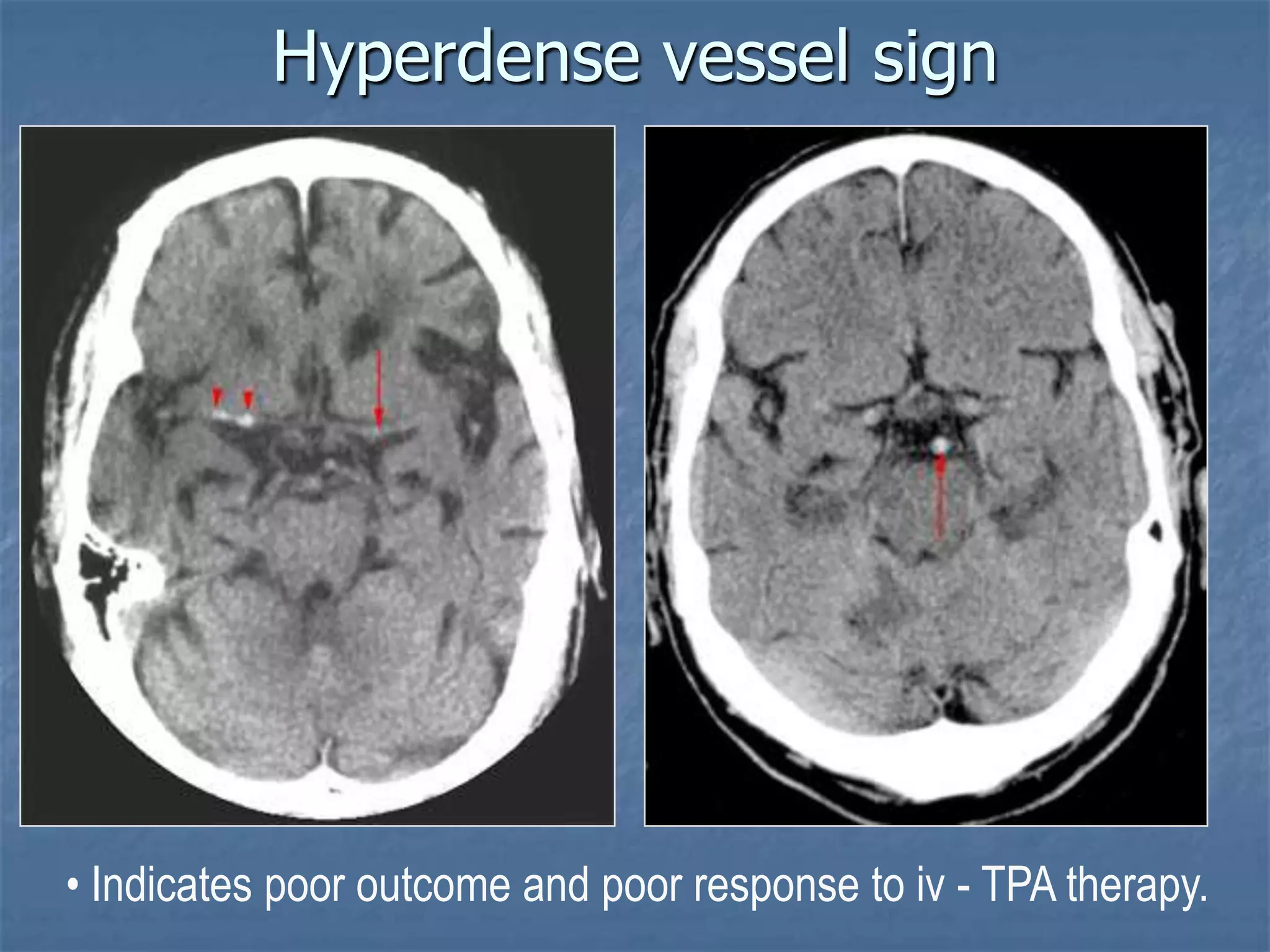 Hyperdense vessel sign
• Indicates poor outcome and poor response to iv - TPA therapy.
 