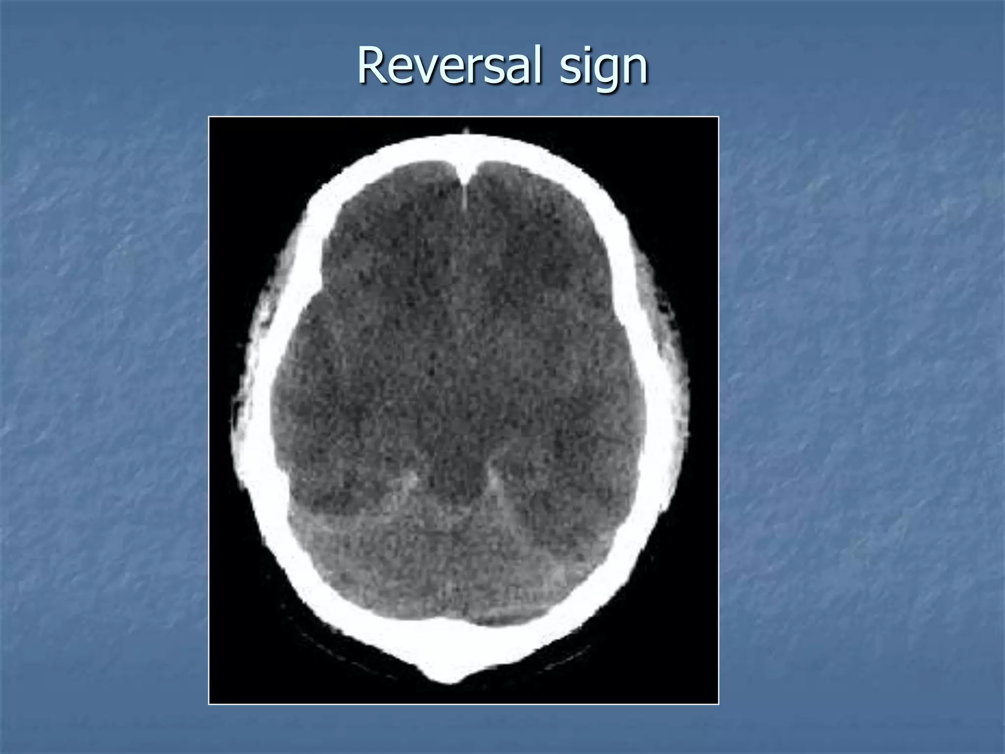 Reversal sign
 