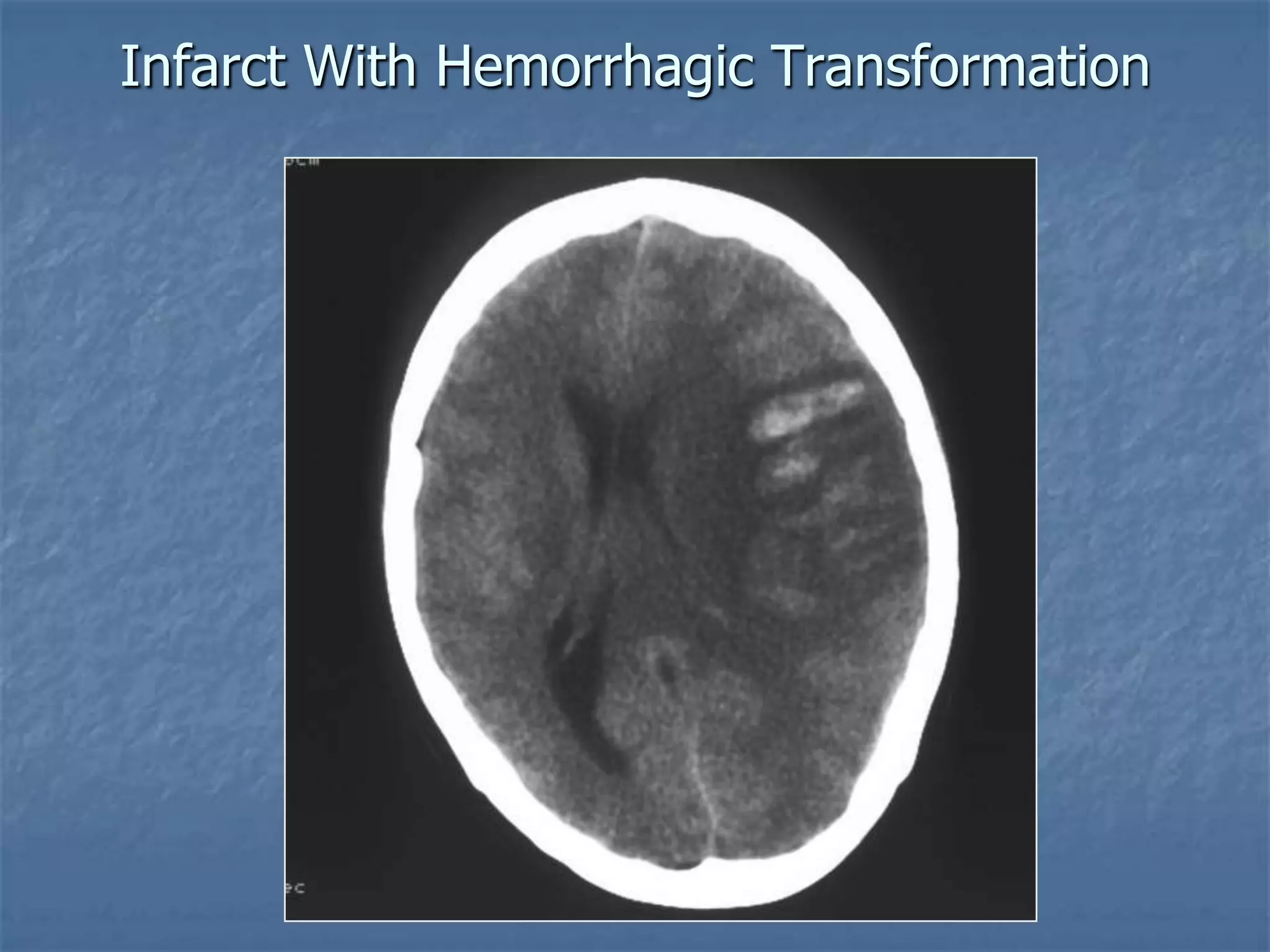 Infarct With Hemorrhagic Transformation
 
