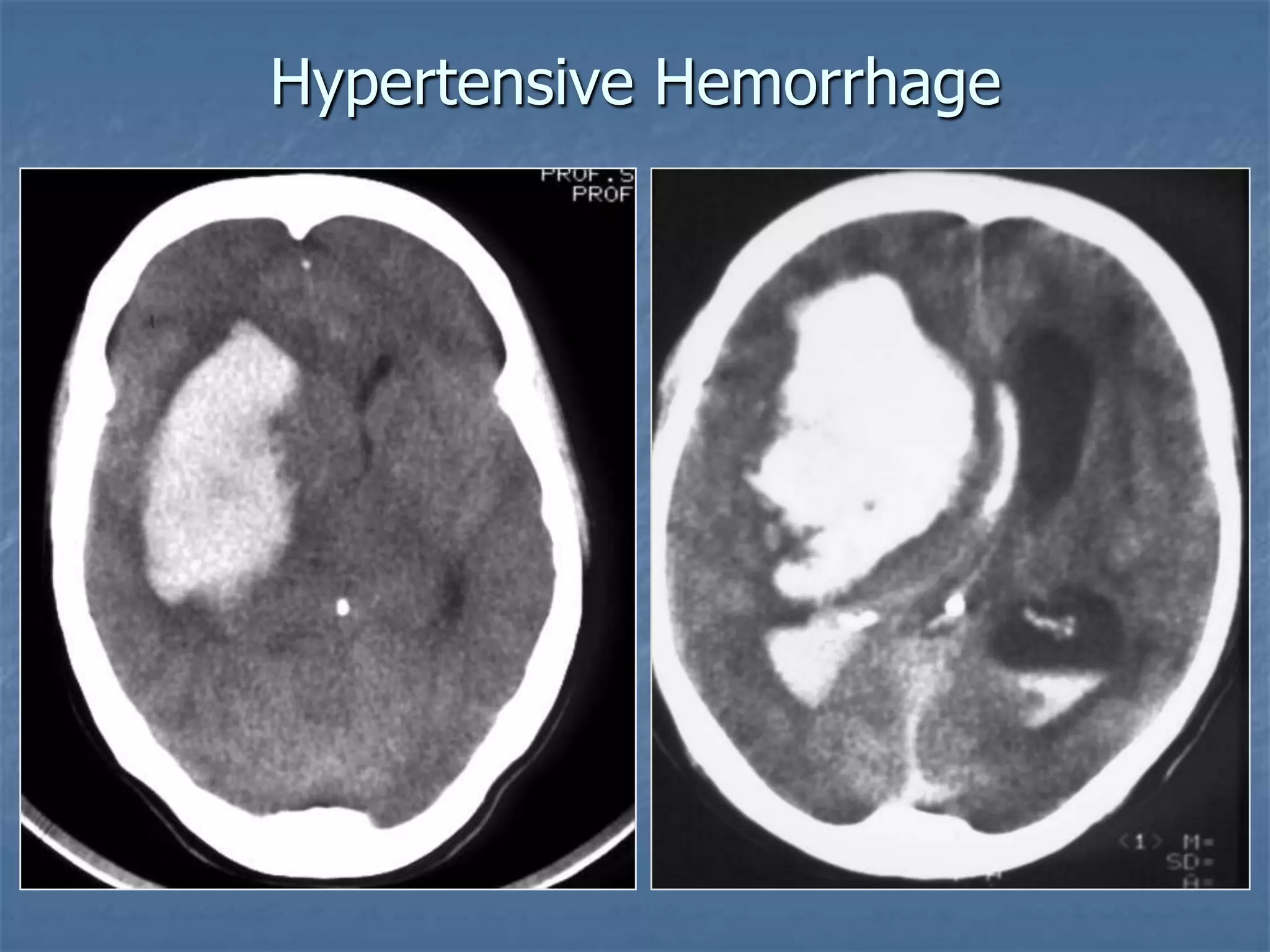 Hypertensive Hemorrhage
 