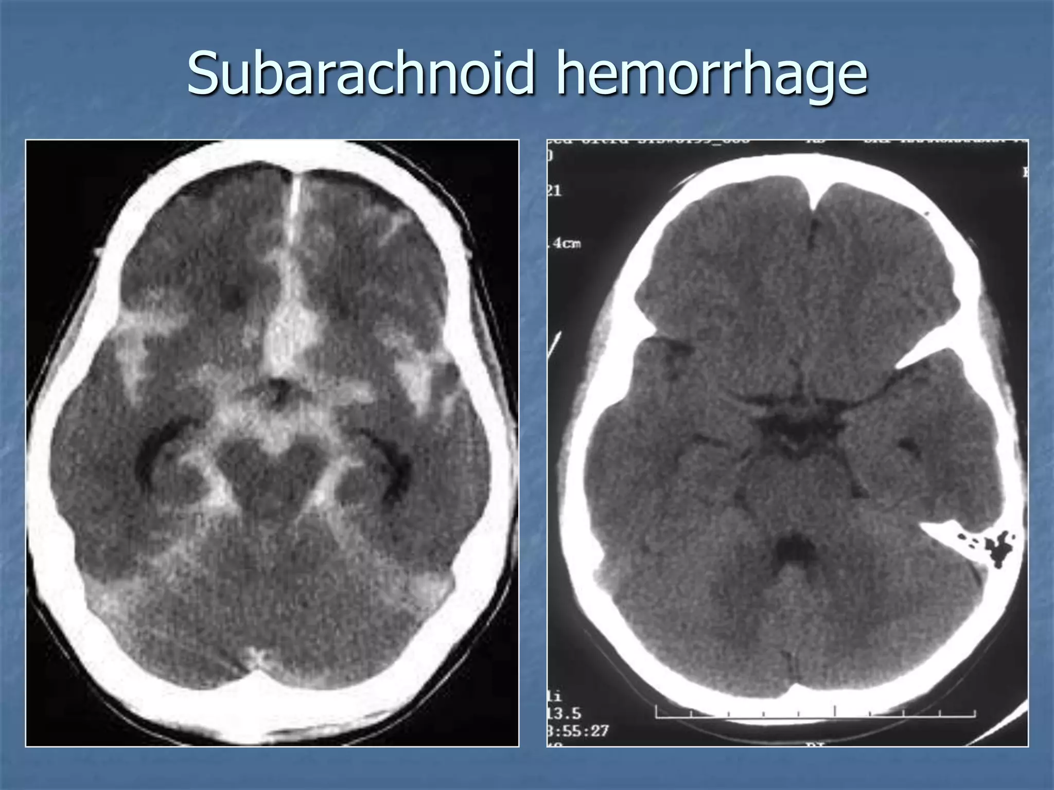 Subarachnoid hemorrhage
 