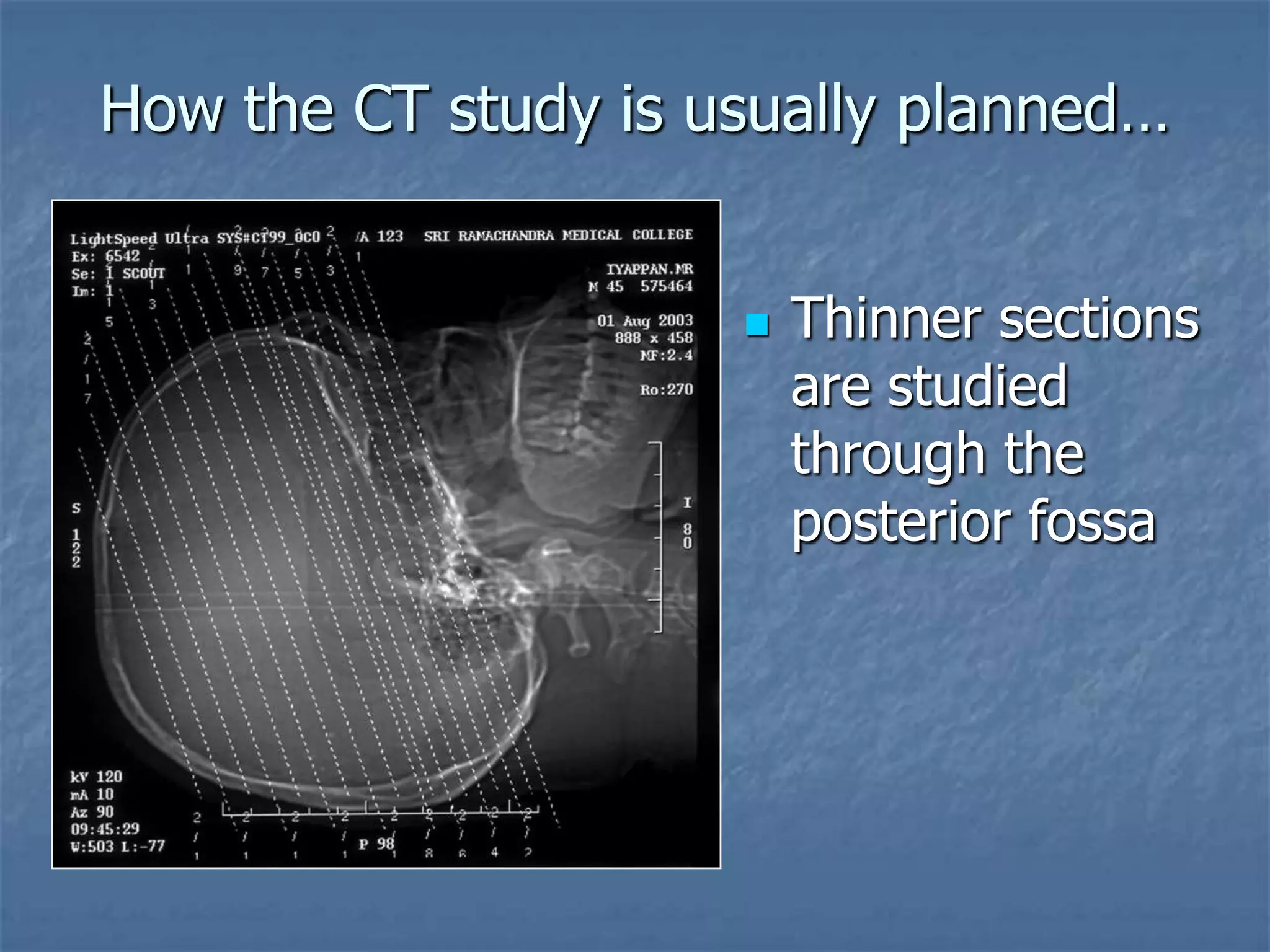 How the CT study is usually planned…
 Thinner sections
are studied
through the
posterior fossa
 