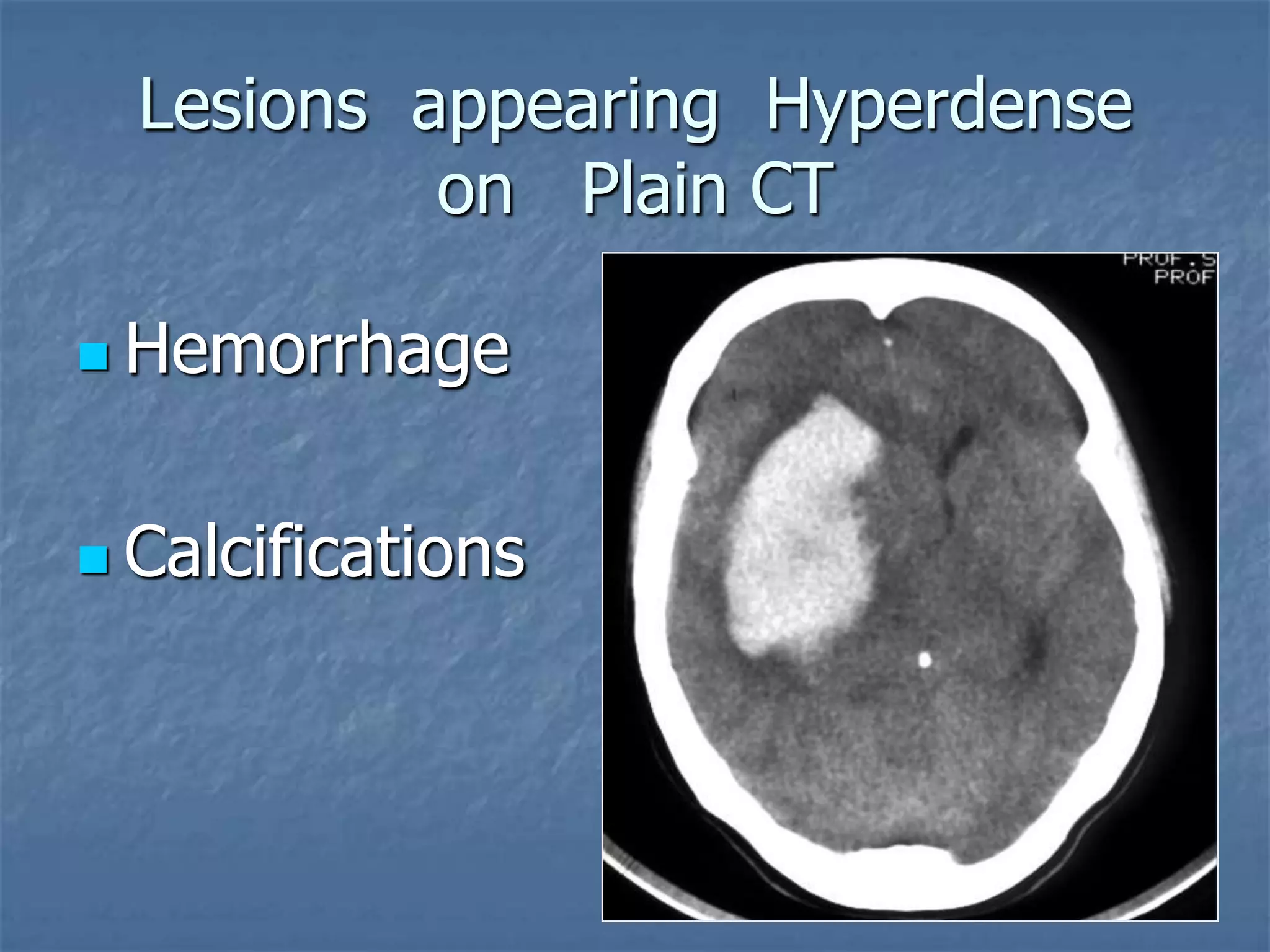 Lesions appearing Hyperdense
on Plain CT
 Hemorrhage
 Calcifications
 