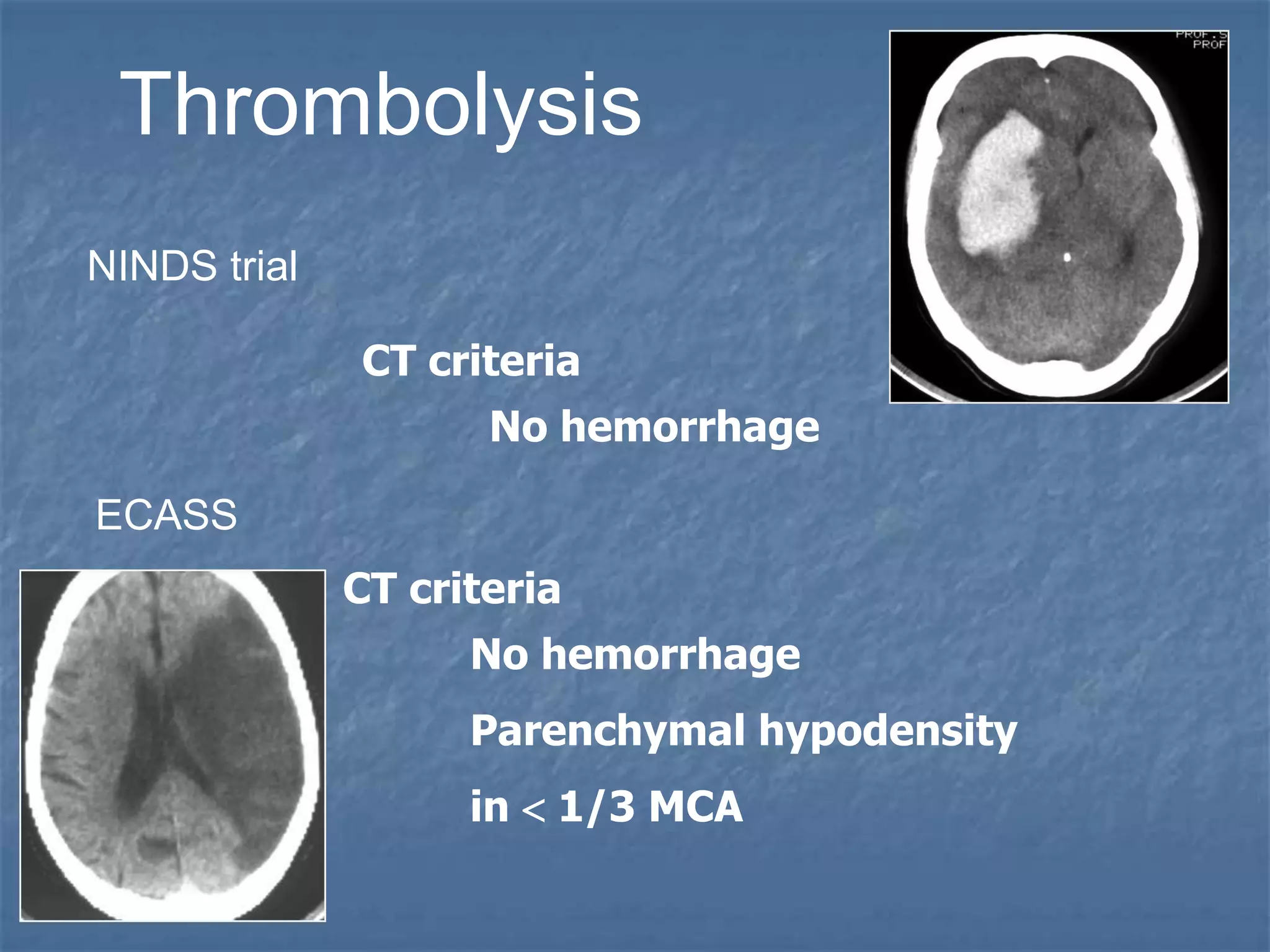 NINDS trial
Thrombolysis
CT criteria
No hemorrhage
CT criteria
No hemorrhage
Parenchymal hypodensity
in  1/3 MCA
ECASS
 
