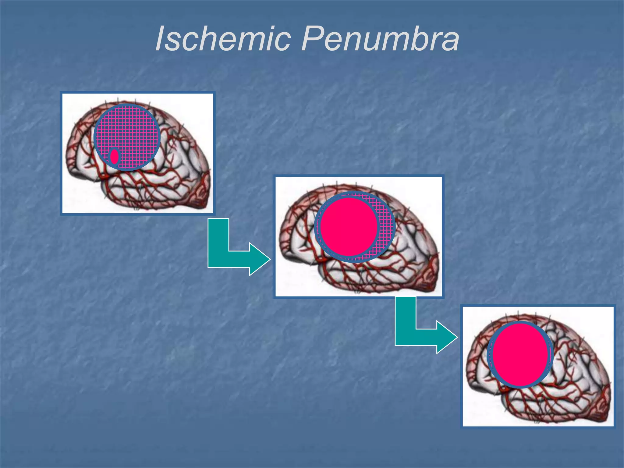 Ischemic Penumbra
 