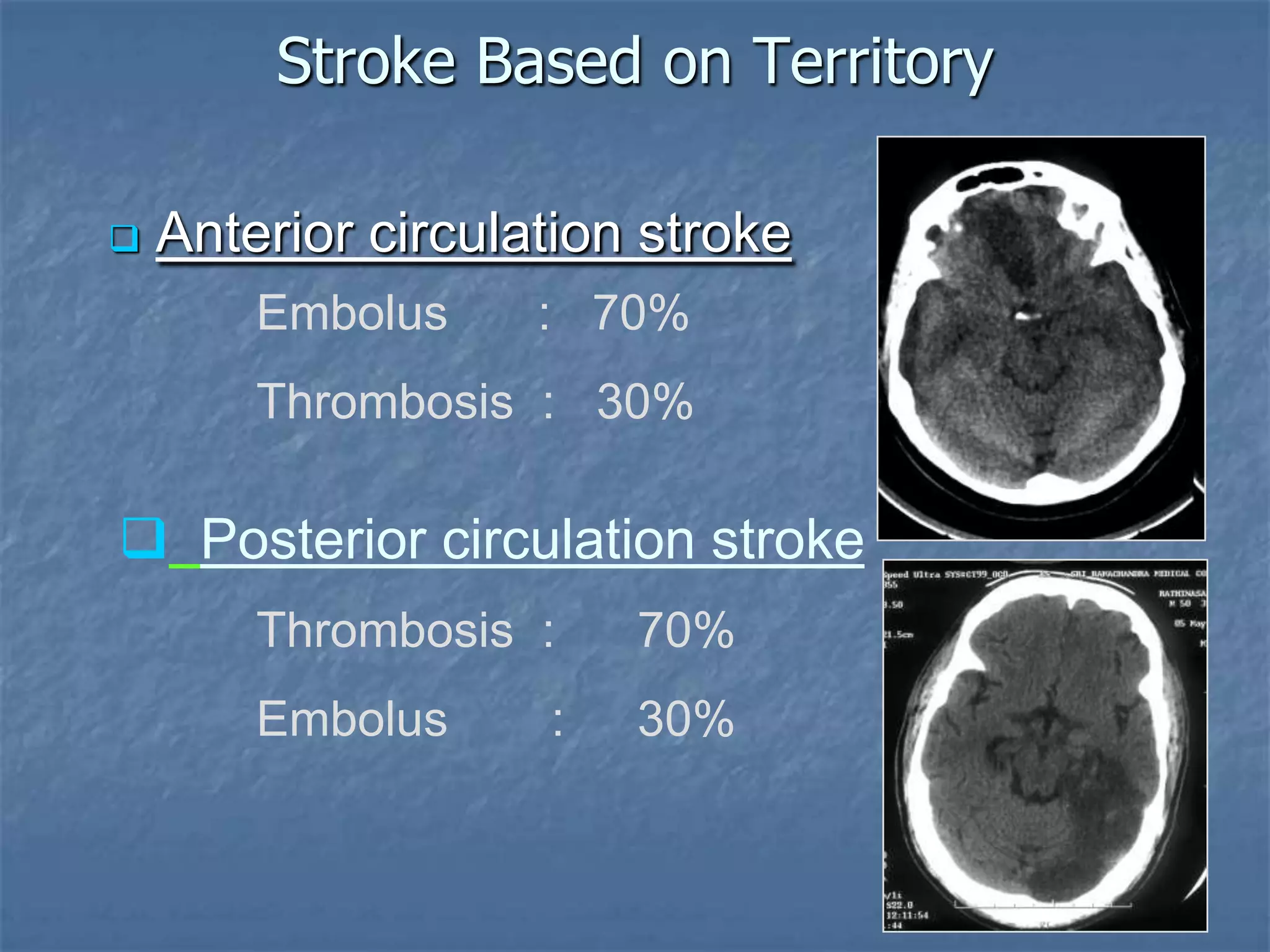 Stroke Based on Territory
 Anterior circulation stroke
Embolus : 70%
Thrombosis : 30%
 Posterior circulation stroke
Thrombosis : 70%
Embolus : 30%
 
