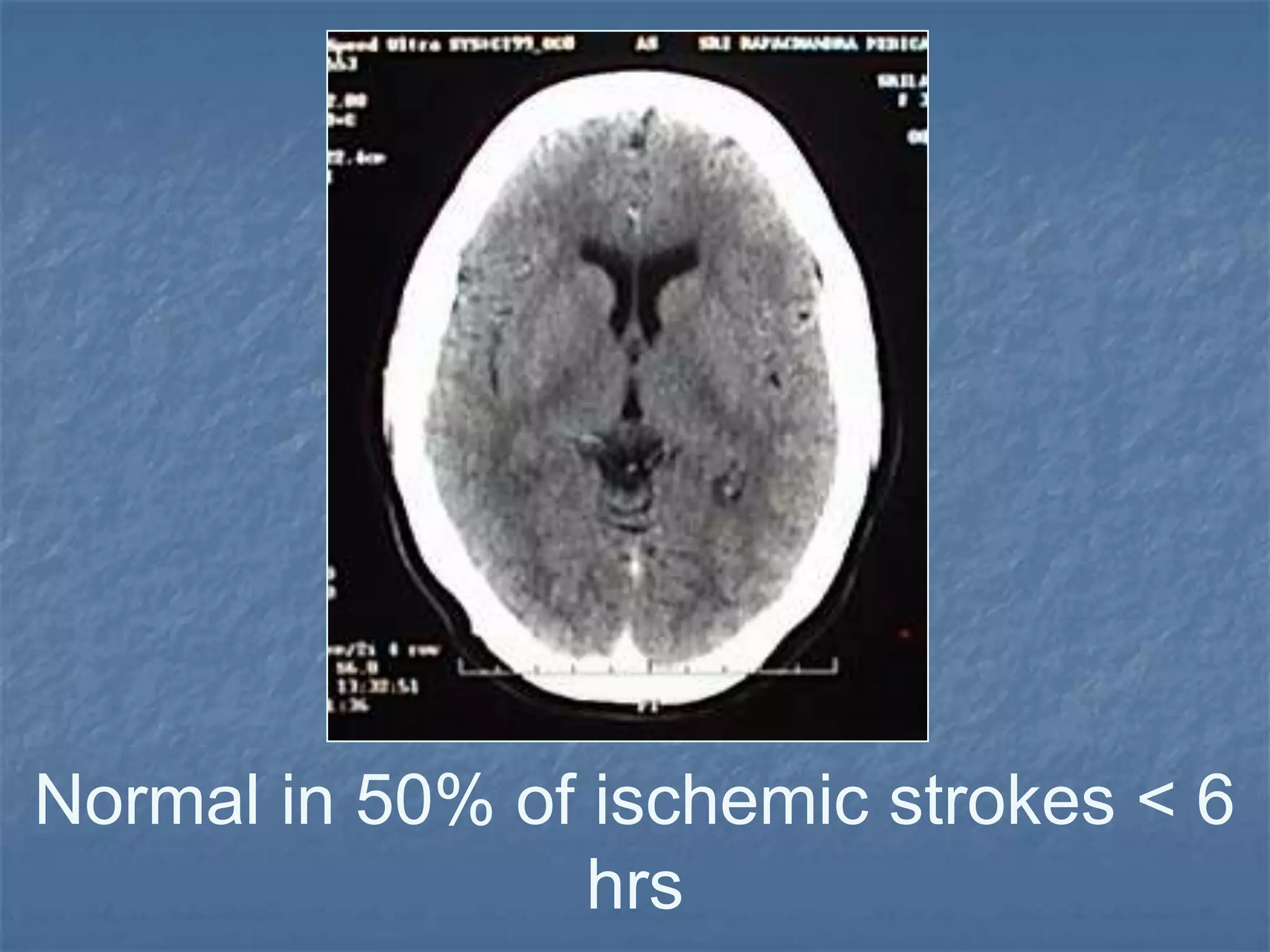 Normal in 50% of ischemic strokes < 6
hrs
 