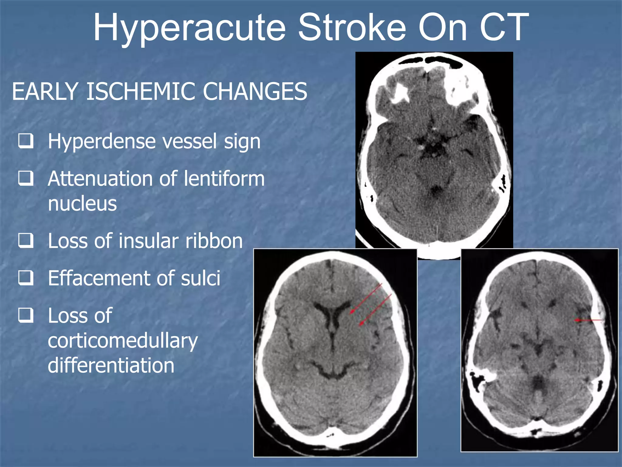 Hyperacute Stroke On CT
EARLY ISCHEMIC CHANGES
 Hyperdense vessel sign
 Attenuation of lentiform
nucleus
 Loss of insular ribbon
 Effacement of sulci
 Loss of
corticomedullary
differentiation
 