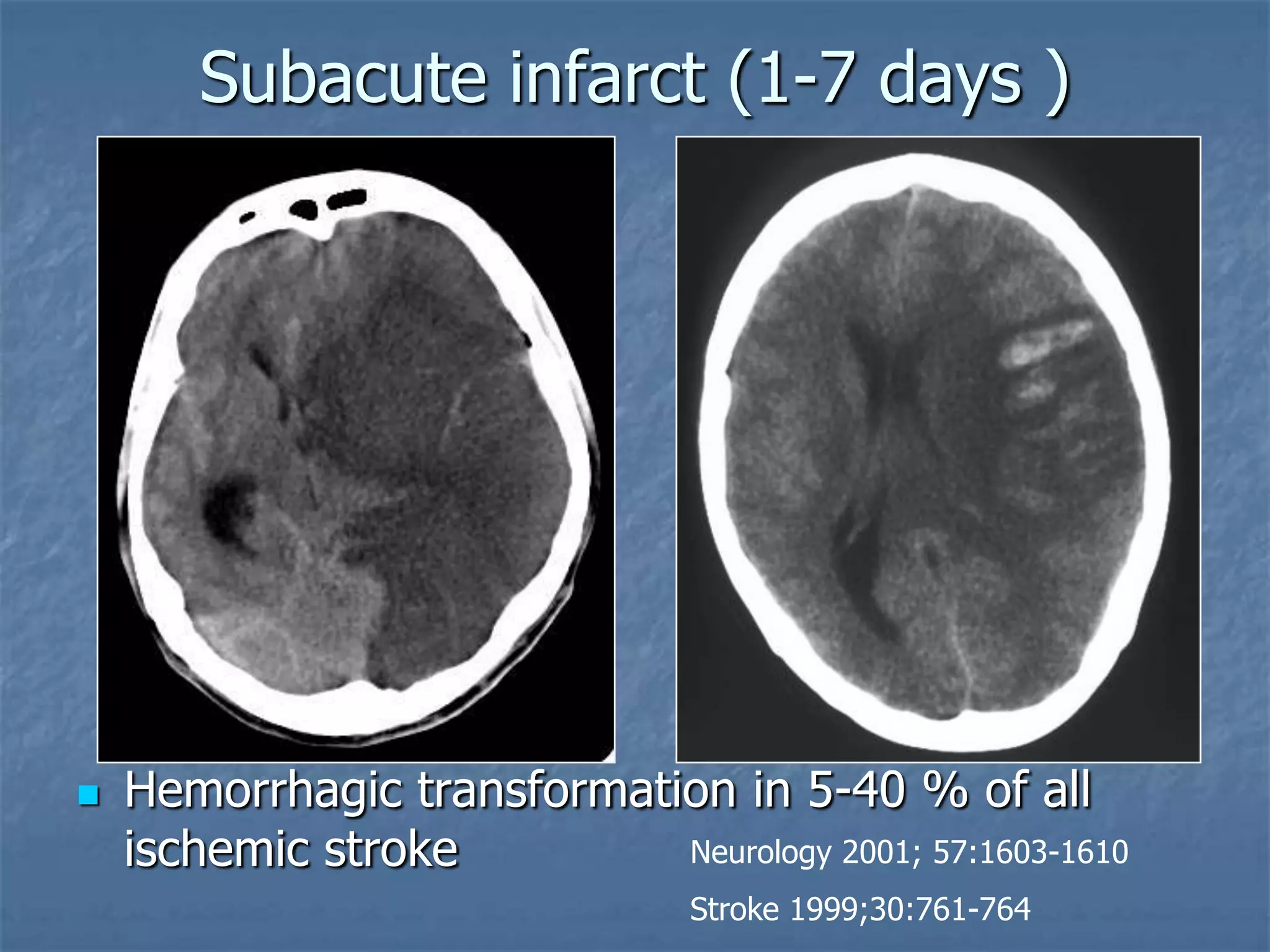 Subacute infarct (1-7 days )
 Hemorrhagic transformation in 5-40 % of all
ischemic stroke Neurology 2001; 57:1603-1610
Stroke 1999;30:761-764
 