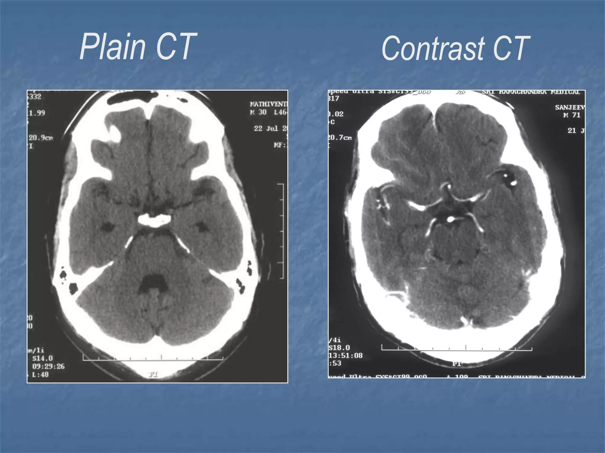 Plain CT Contrast CT
 