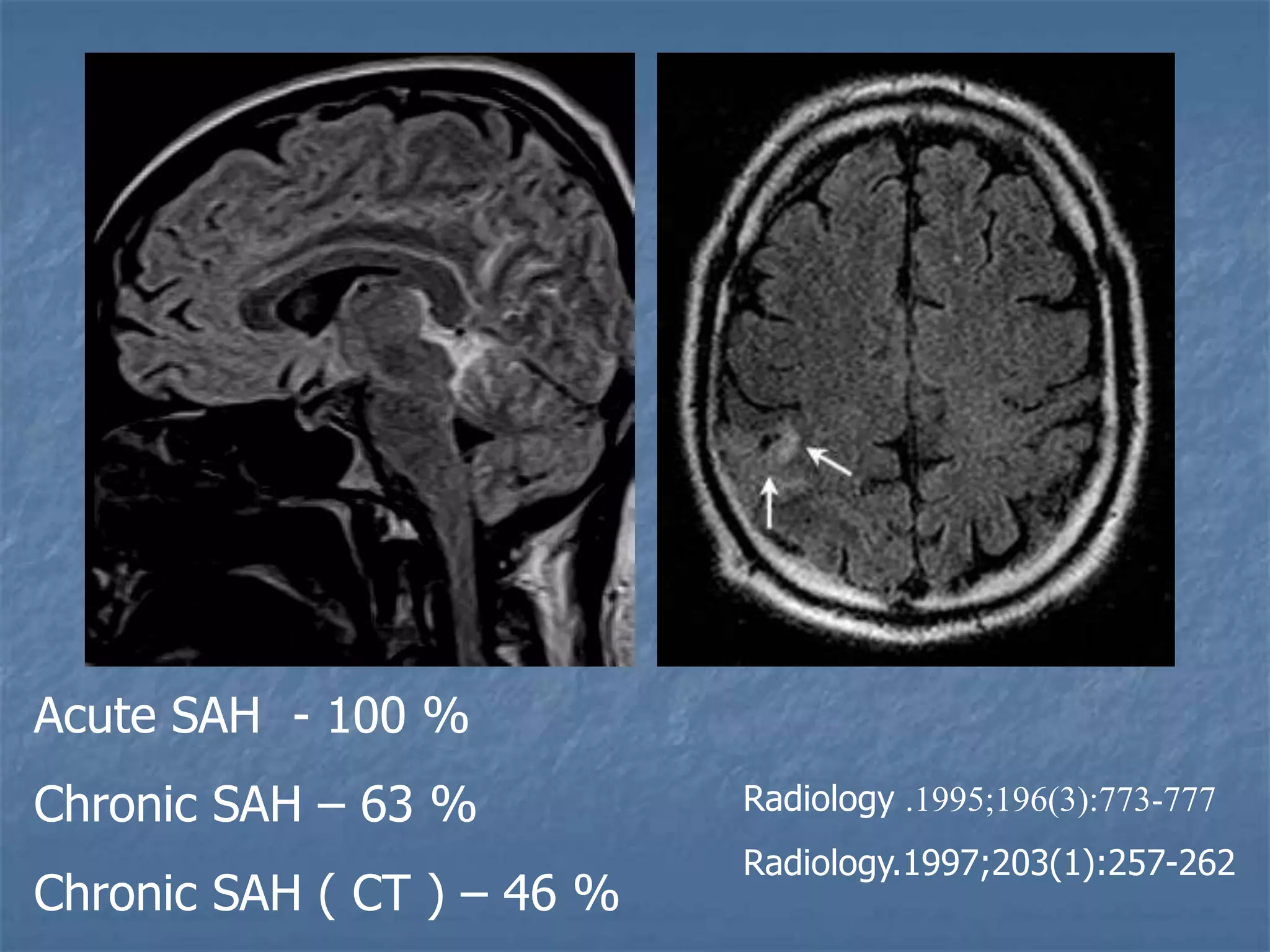 Acute SAH - 100 %
Chronic SAH – 63 %
Chronic SAH ( CT ) – 46 %
Radiology .1995;196(3):773-777
Radiology.1997;203(1):257-262
 
