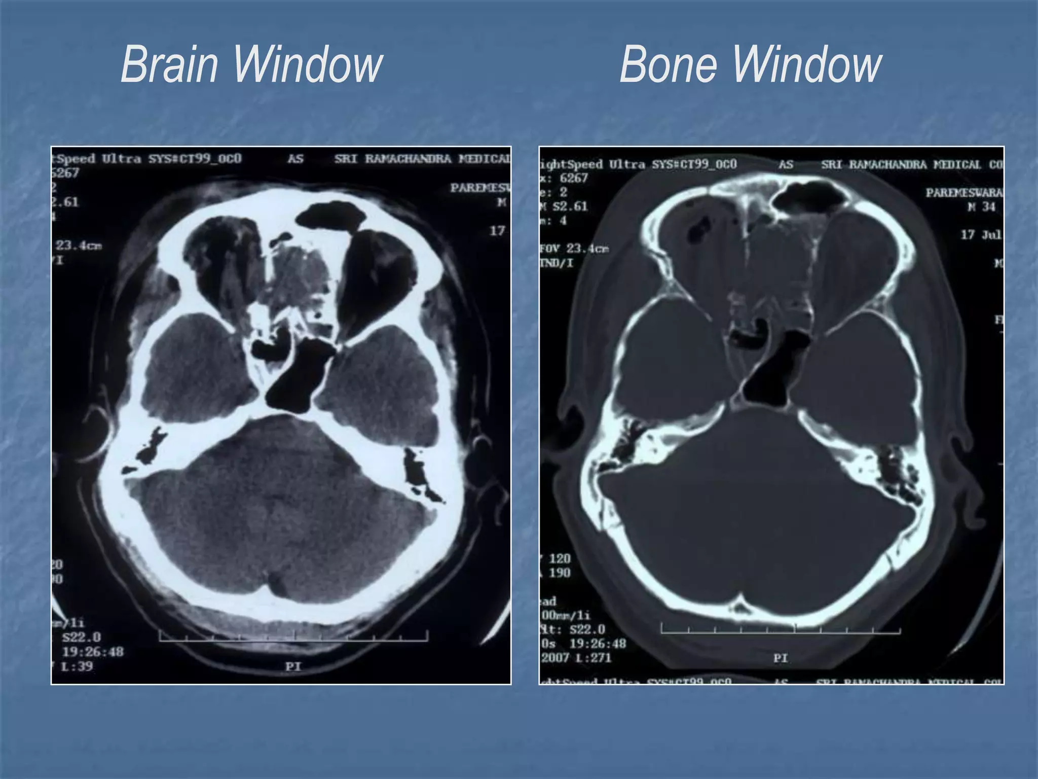 Brain Window Bone Window
 