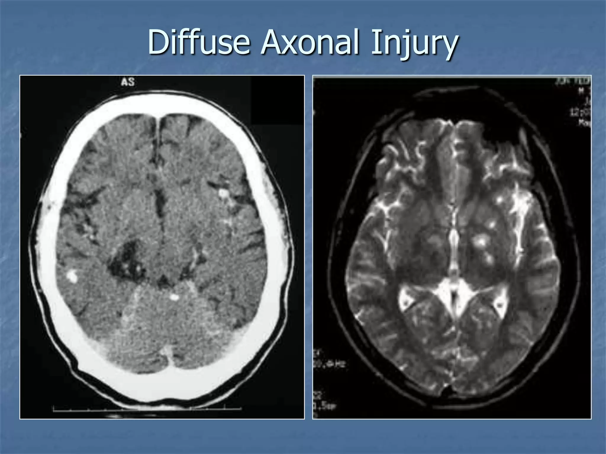Diffuse Axonal Injury
 