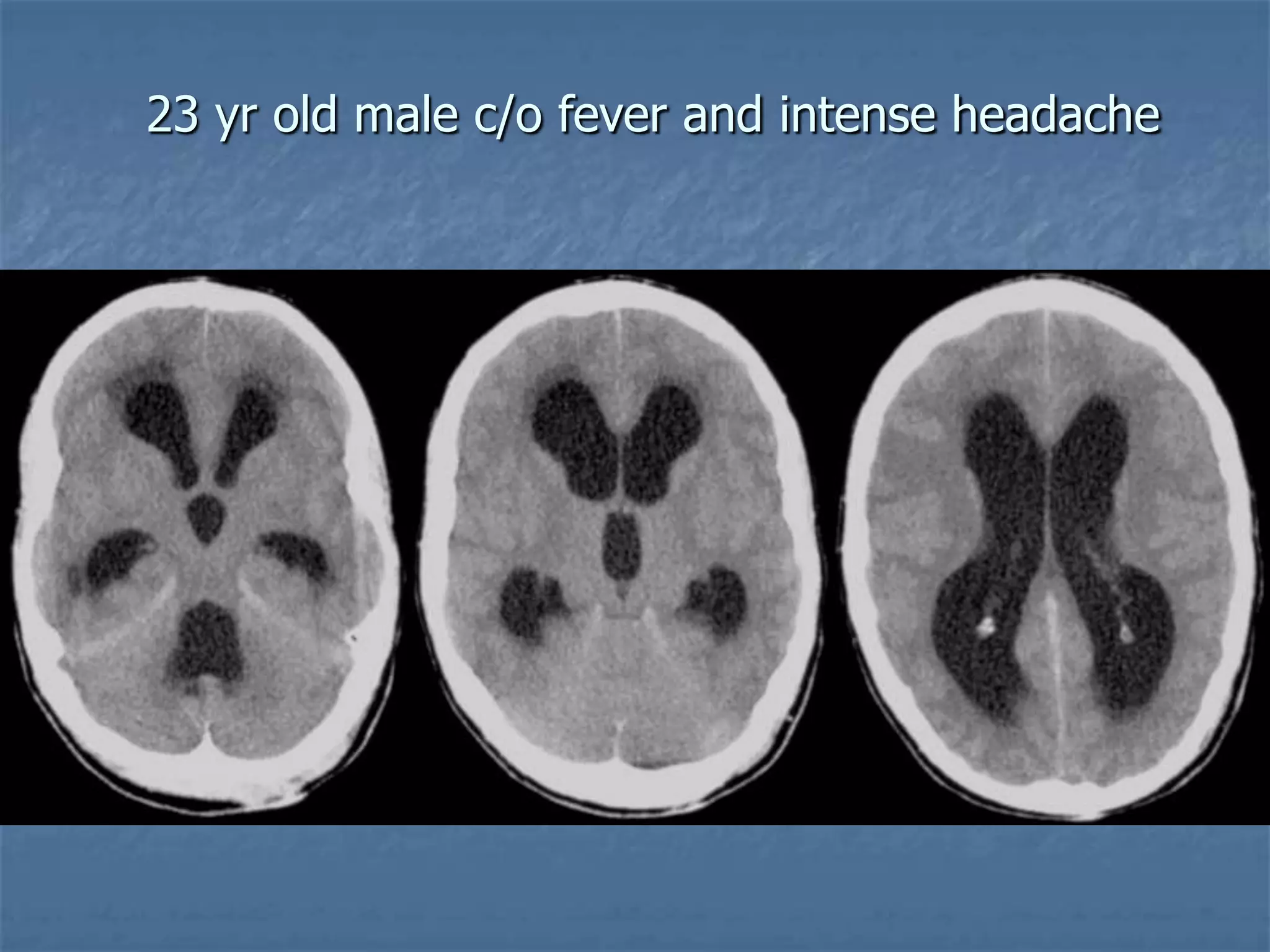 23 yr old male c/o fever and intense headache
 