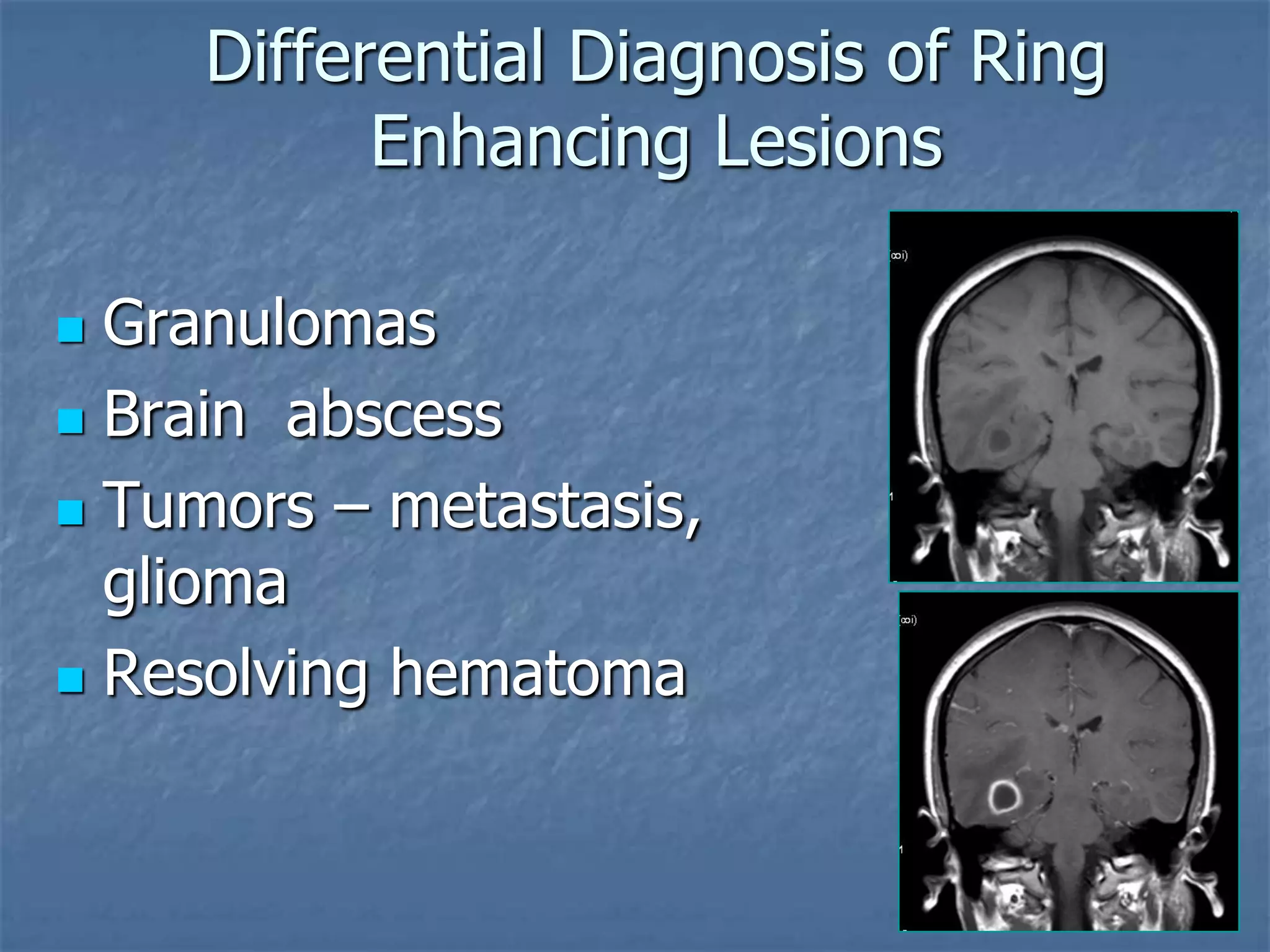 Differential Diagnosis of Ring
Enhancing Lesions
 Granulomas
 Brain abscess
 Tumors – metastasis,
glioma
 Resolving hematoma
 