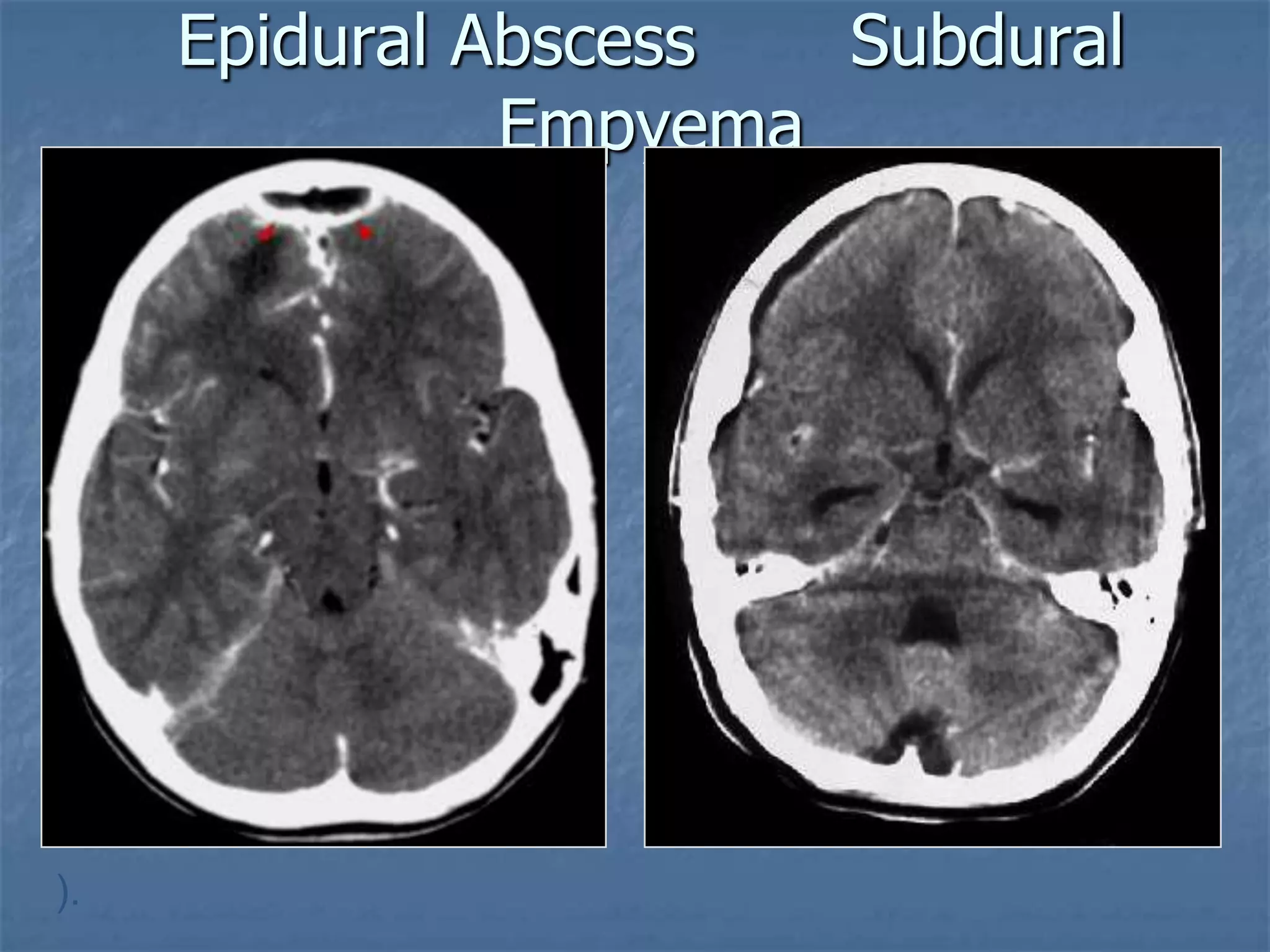 Epidural Abscess Subdural
Empyema
 Notice the rim enhancing
epdural fluid collection
(arrowheads)
).
 
