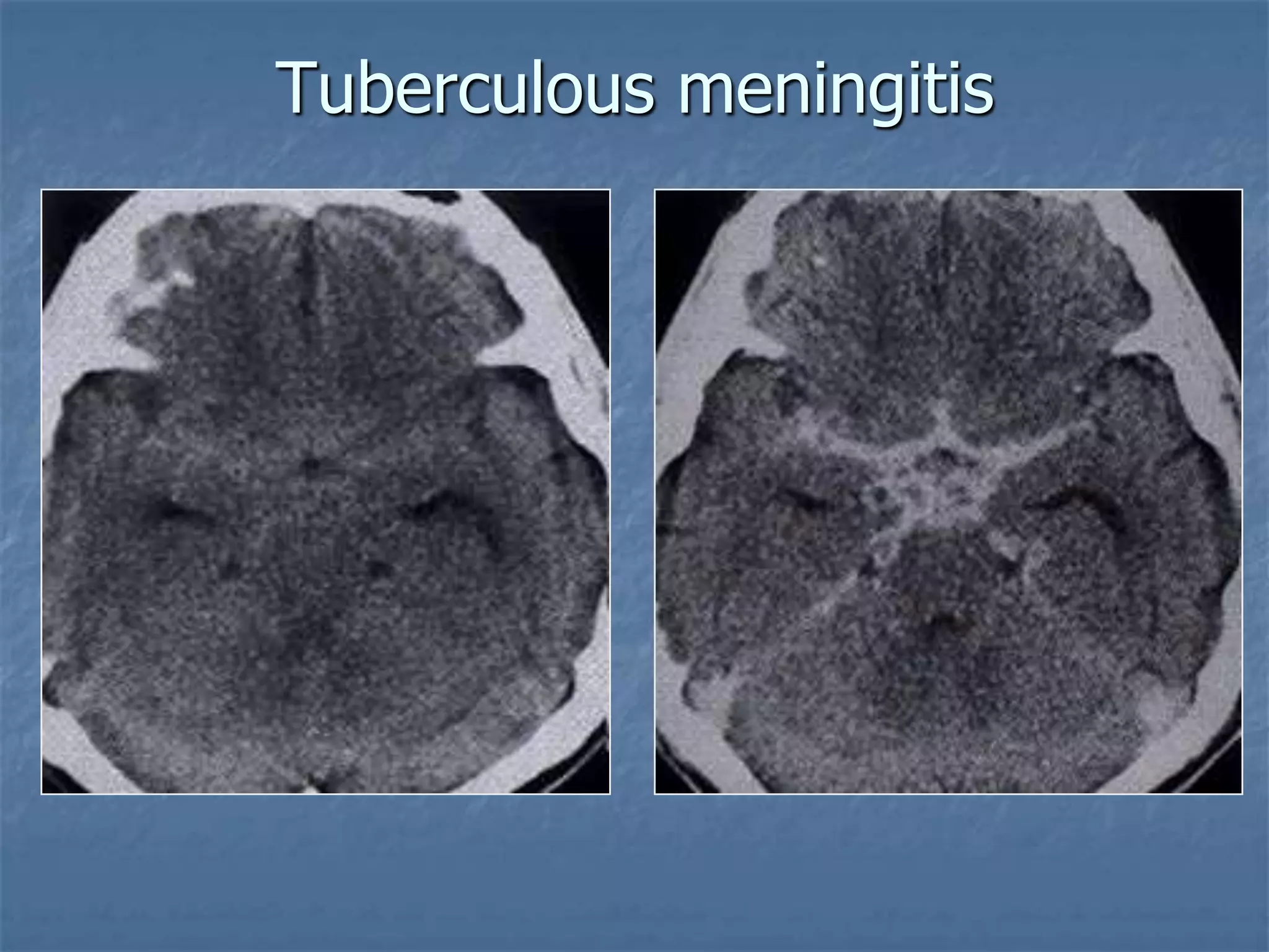 Tuberculous meningitis
 