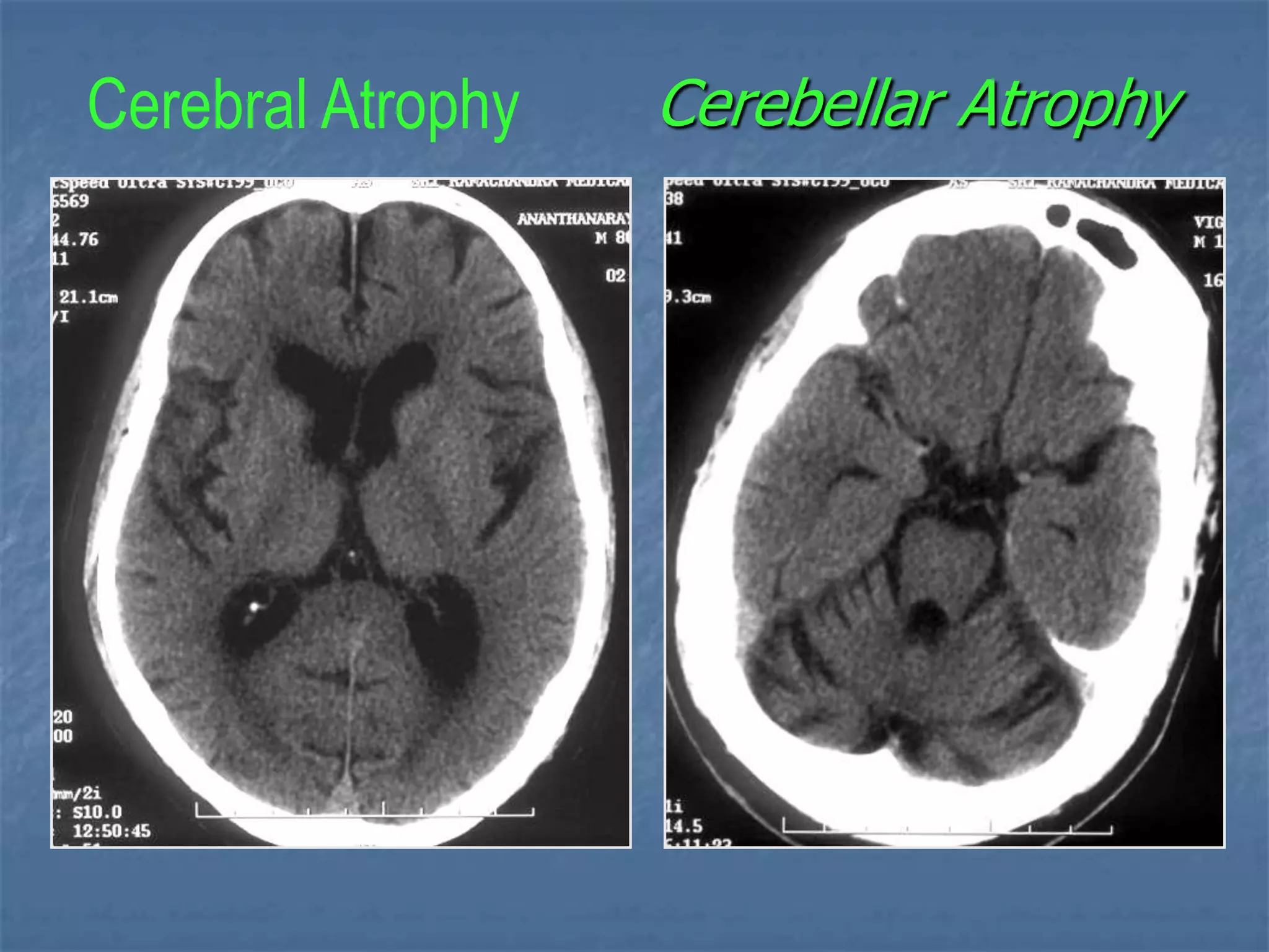 Cerebellar AtrophyCerebral Atrophy
 