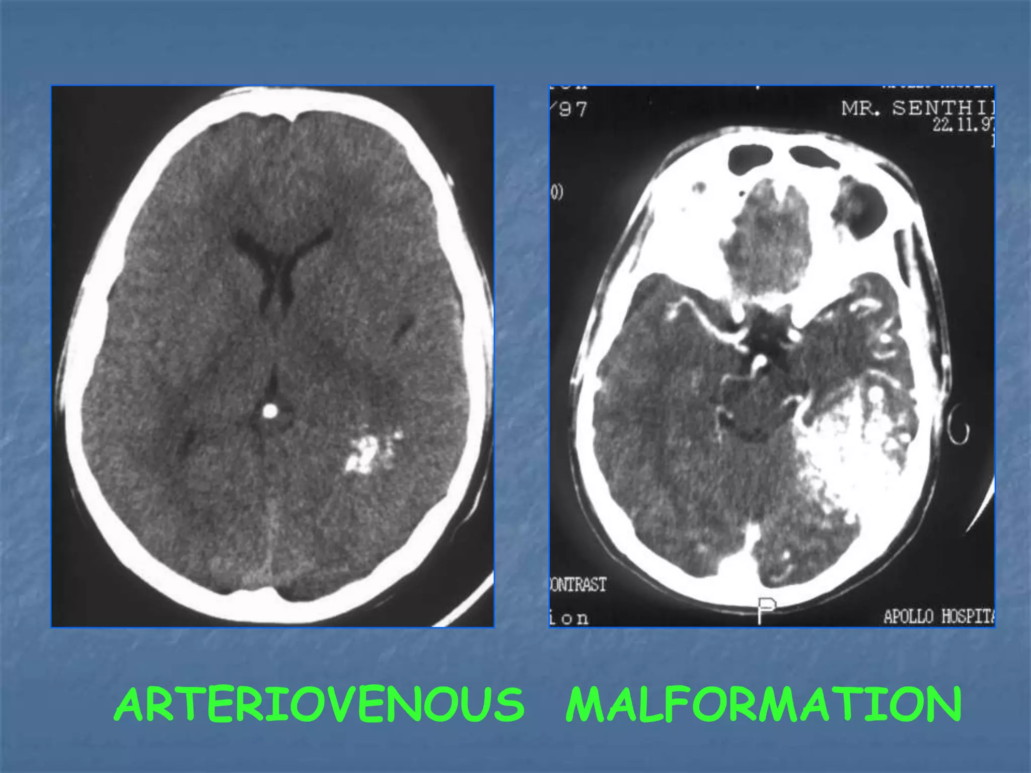 ARTERIOVENOUS MALFORMATION
 