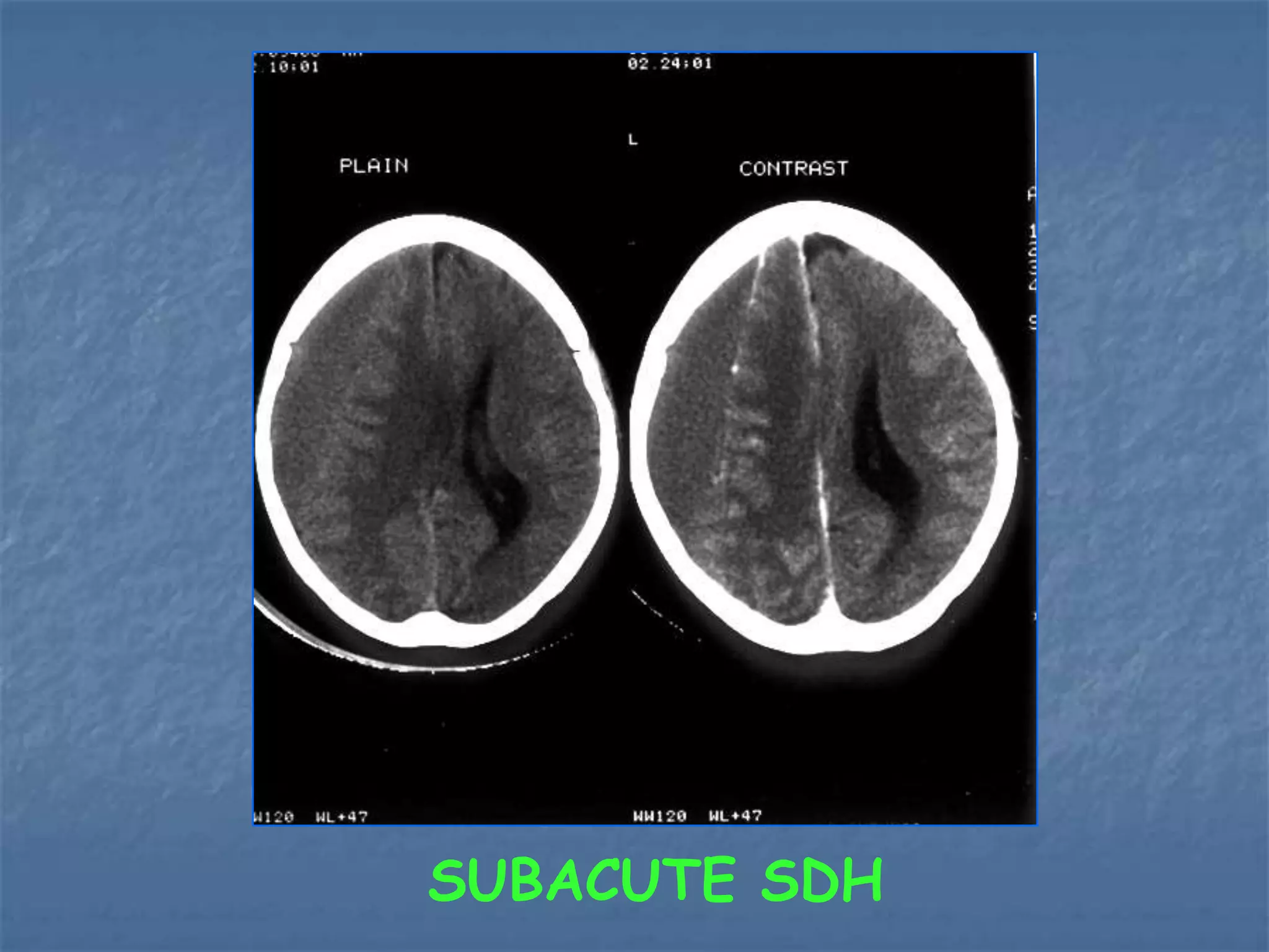 SUBACUTE SDH
 