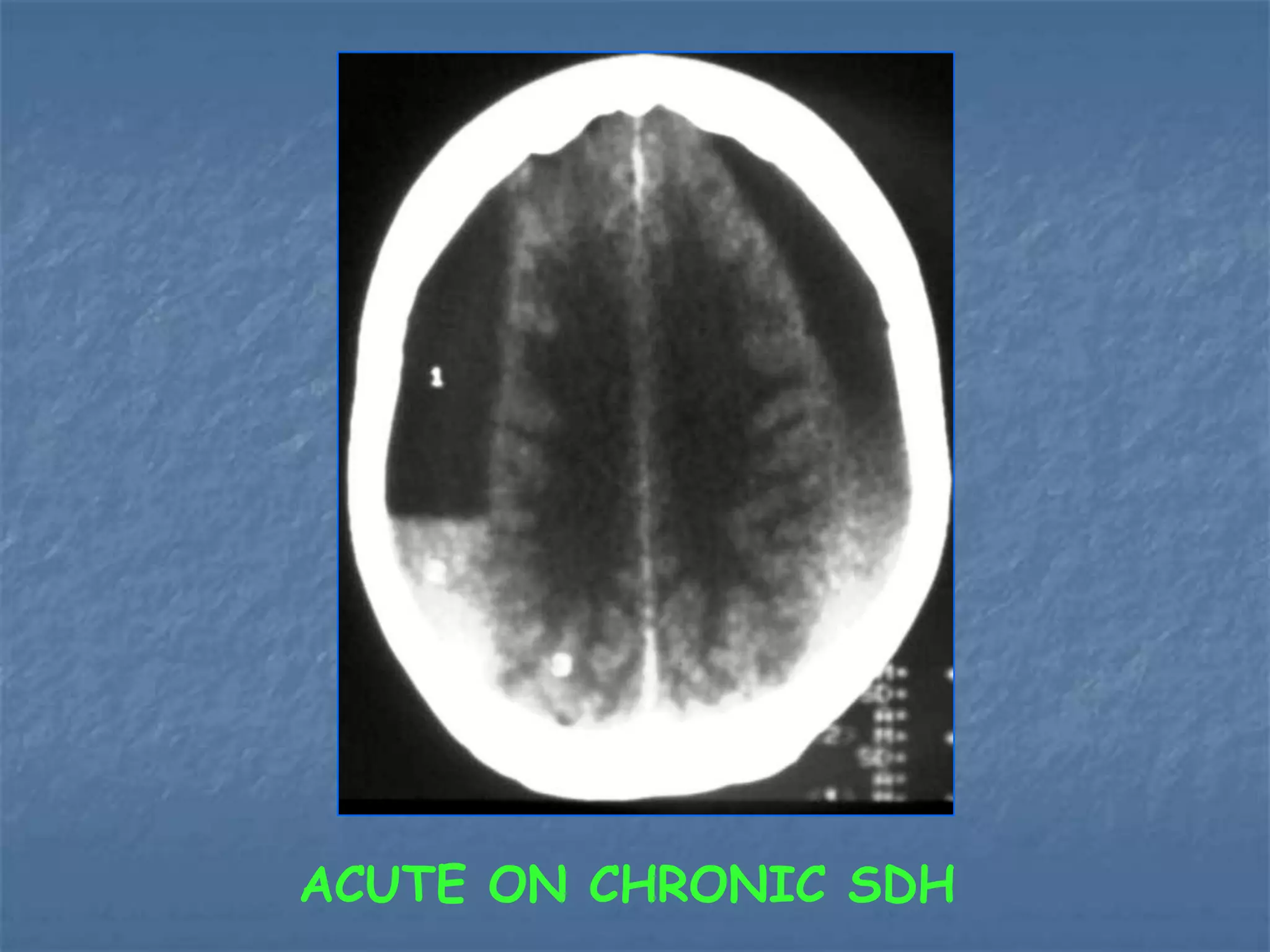ACUTE ON CHRONIC SDH
 