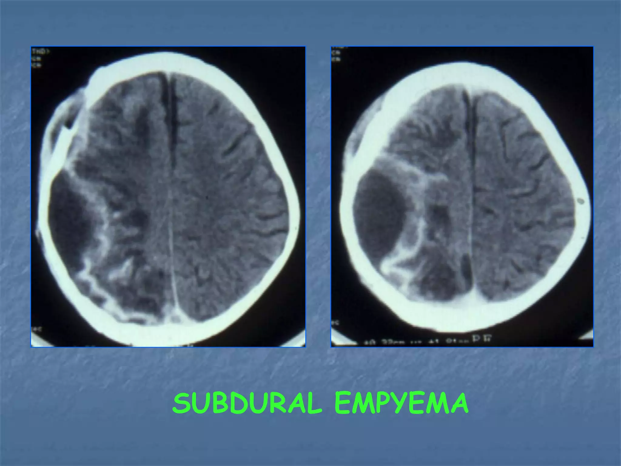 SUBDURAL EMPYEMA
 