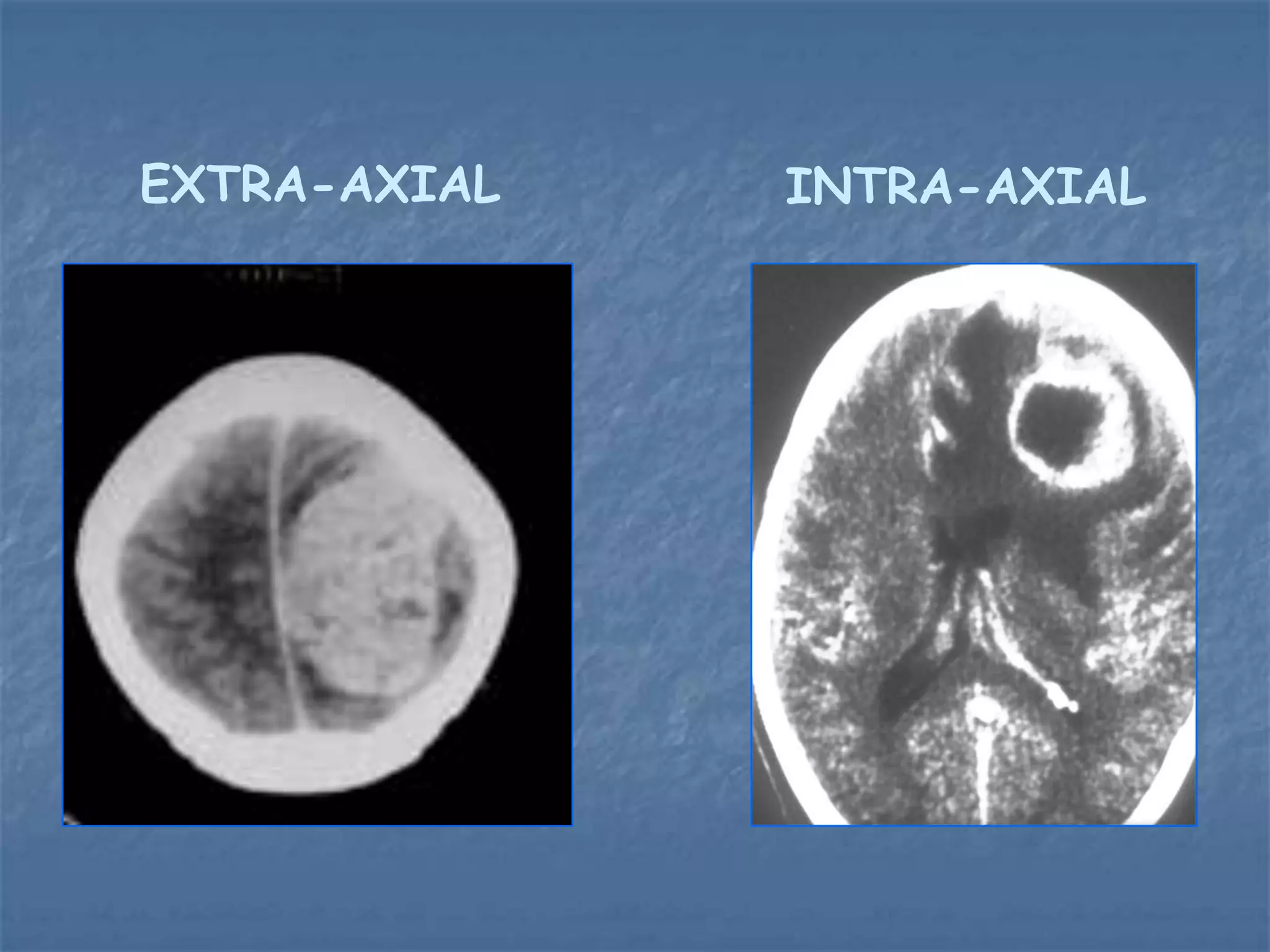 EXTRA-AXIAL INTRA-AXIAL
 