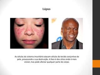 Lúpus




As células do sistema imunitário atacam células do tecido conjuntivo da
   pele, provocando a sua destruição. A face é dos sítios onde é mais
           visível, mas pode afectar qualquer parte do corpo.
 