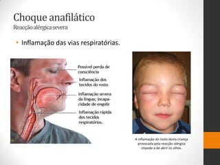 Choque anafilático
Reacçãoalérgica severa

 • Inflamação das vias respiratórias.




                                        A inflamação do rosto desta criança
                                          provocada pela reacção alérgica
                                            impede-a de abrir os olhos.
 