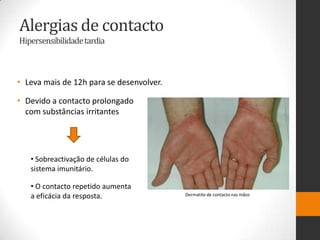 Alergias de contacto
Hipersensibilidade tardia



• Leva mais de 12h para se desenvolver.

• Devido a contacto prolongado
  com substâncias irritantes




   • Sobreactivação de células do
   sistema imunitário.

   • O contacto repetido aumenta
   a eficácia da resposta.                Dermatite de contacto nas mãos
 