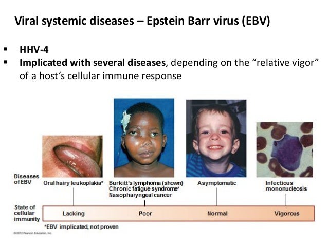 how to kill epstein barr virus how to kill epstein barr virus