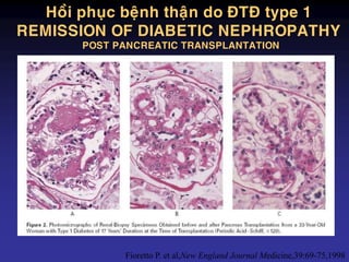 Hoài phuïc beänh thaän do ÑTÑ type 1
REMISSION OF DIABETIC NEPHROPATHY
POST PANCREATIC TRANSPLANTATION
Fioretto P. et al,New England Journal Medicine,39:69-75,1998
 