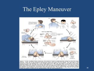 The Epley Maneuver
38
 