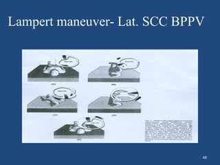 Lampert maneuver- Lat. SCC BPPV
48
 