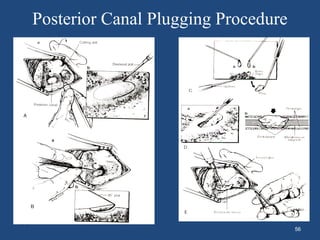 Posterior Canal Plugging Procedure
56
 