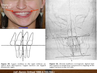 (ref:-Semin Orthod 1998;4:153-164.)
 