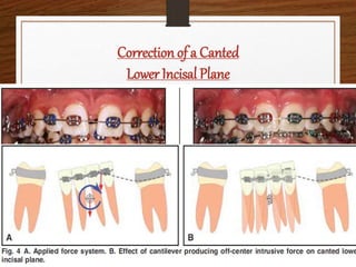 Correction of a Canted
Lower Incisal Plane
Ref:-JCO,2006;VOLUME XL NUMBER 9
 