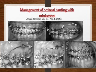 Management of occlusal canting with
miniscrews
Angle Orthod, Vol 84, No 4, 2014
 