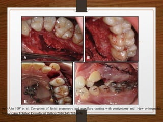 (ref:-Ahn HW et al; Correction of facial asymmetry and maxillary canting with corticotomy and 1-jaw orthognathic
Surgery;Am J Orthod Dentofacial Orthop 2014;146:795-805)
 